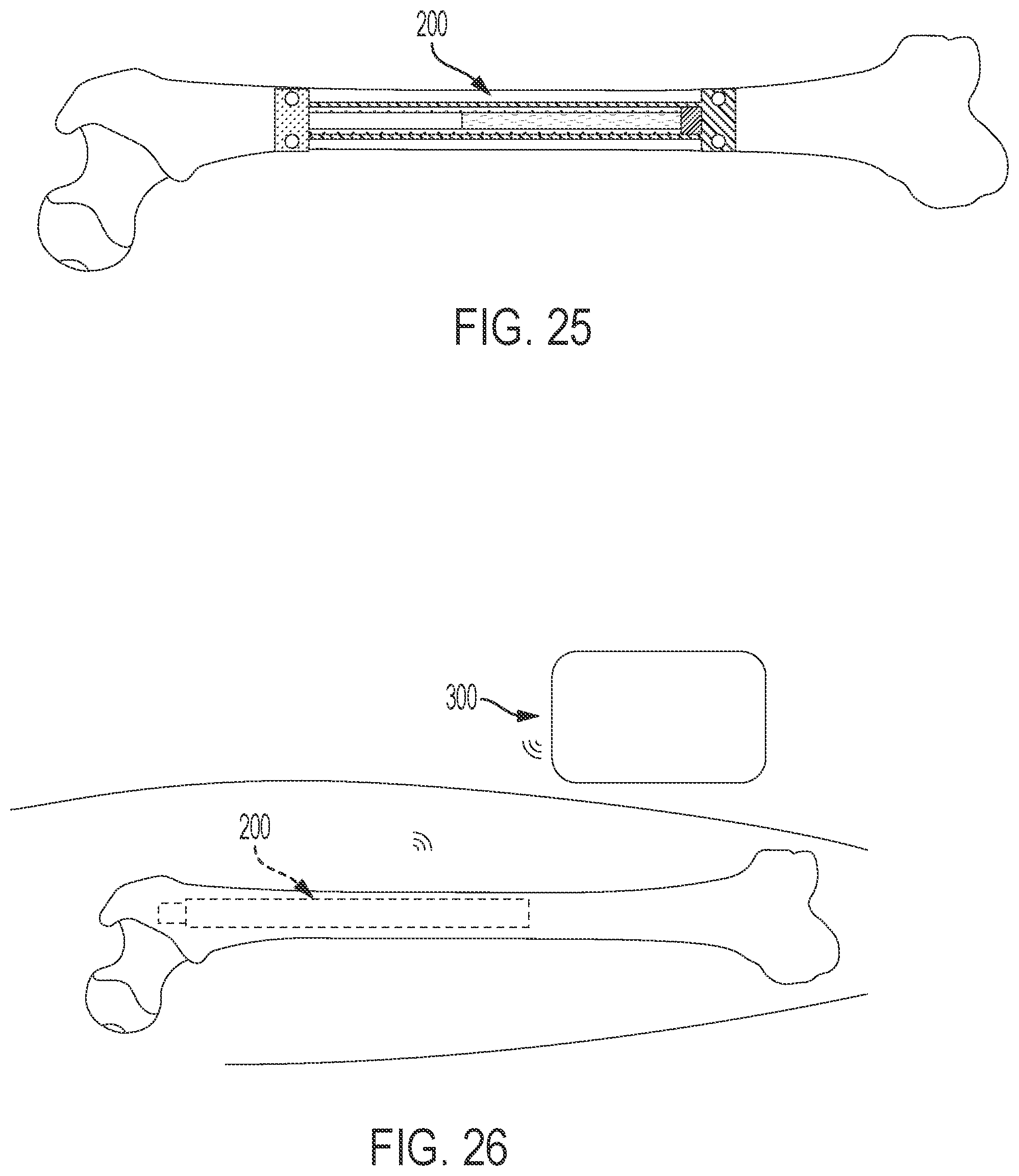 Patent US12303169 Figure 13 – Bone elongating devices and methods of use