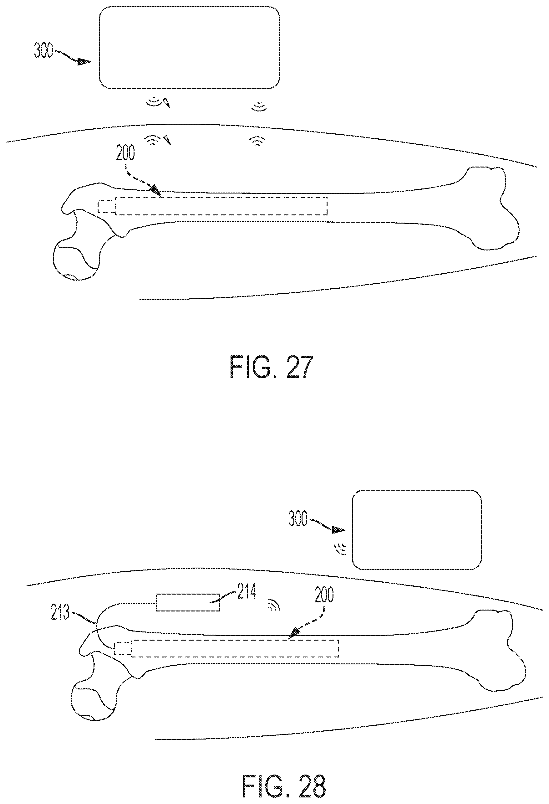 Patent US12303169 Figure 14 – Bone elongating devices and methods of use
