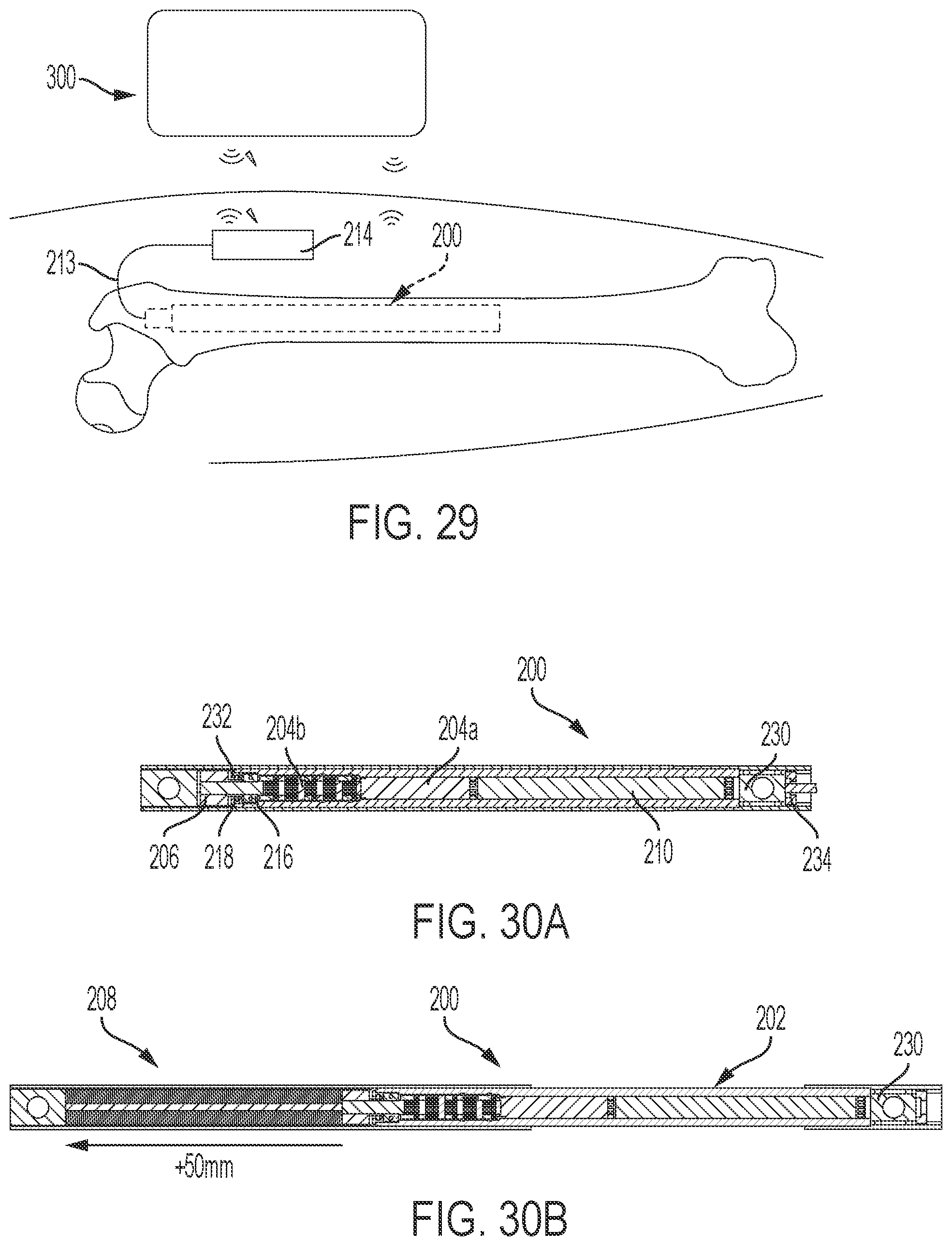 Patent US12303169 Figure 15 – Bone elongating devices and methods of use