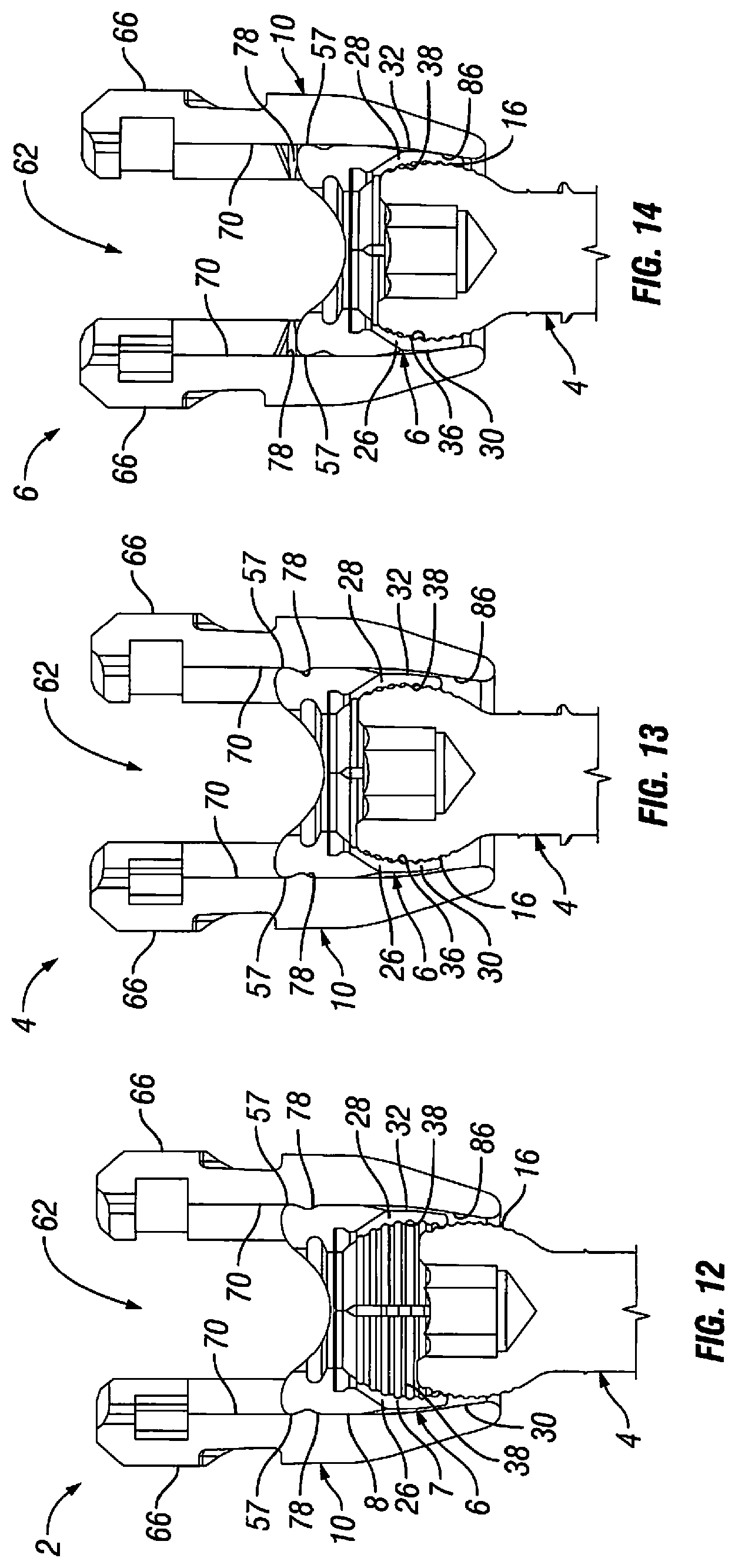 Patent US12303170 Figure 7 – Orthopedic fixation devices and methods of installation thereof
