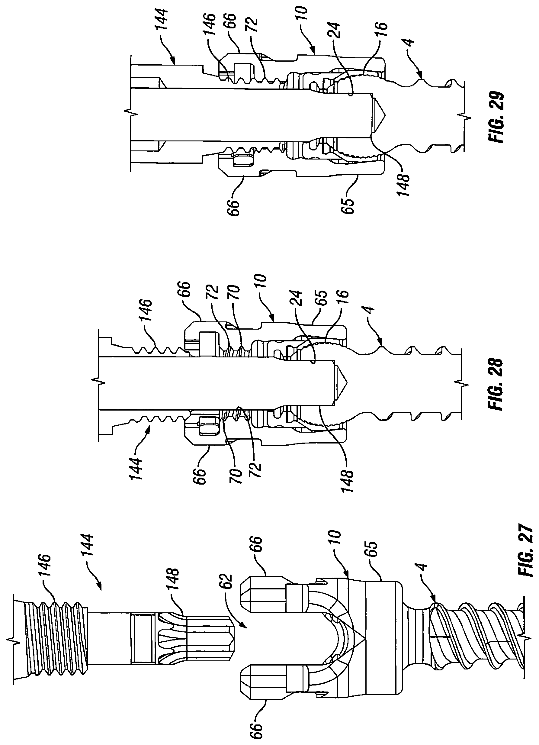 Patent US12303170 Figure 16 – Orthopedic fixation devices and methods of installation thereof