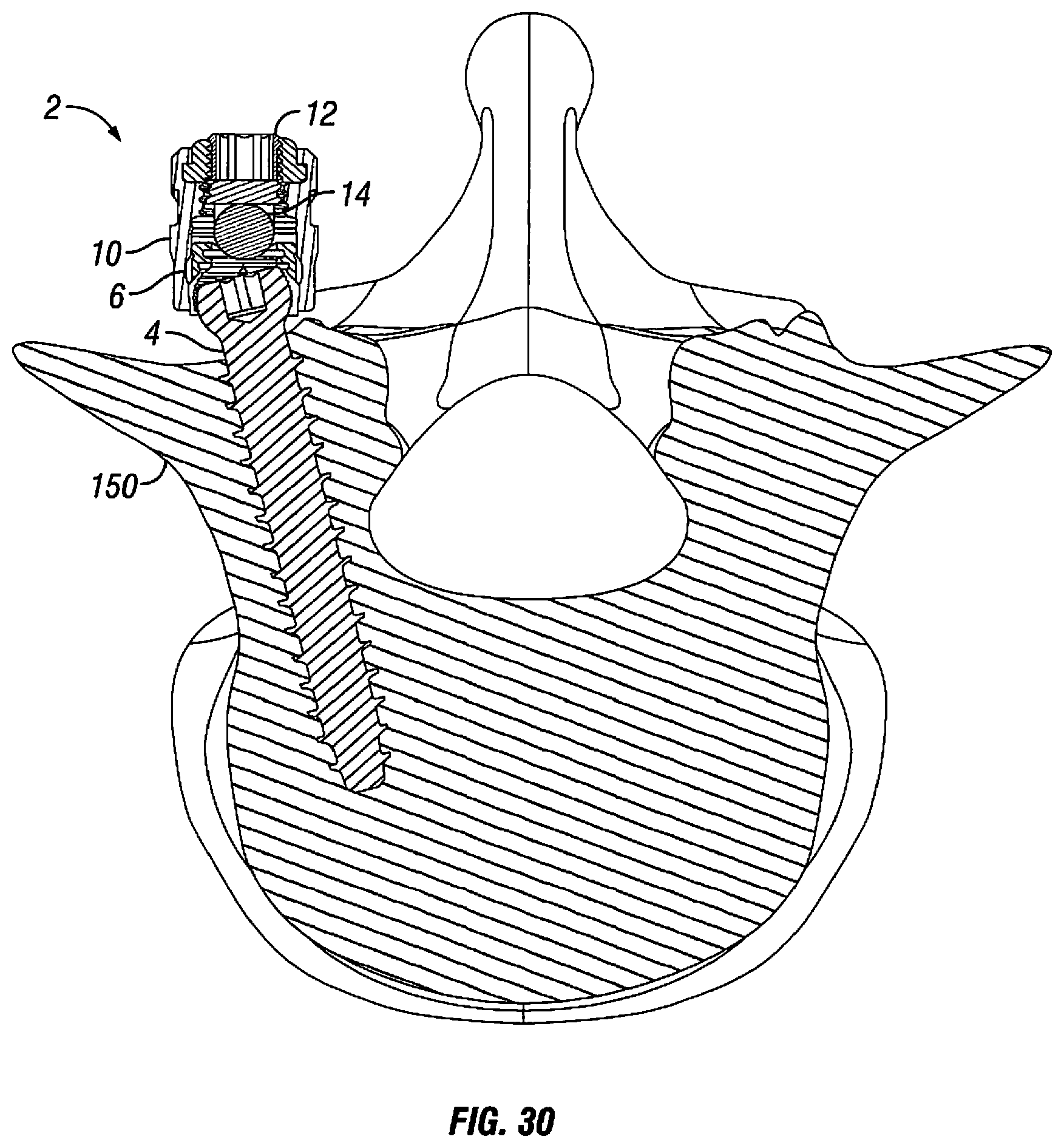 Patent US12303170 Figure 17 – Orthopedic fixation devices and methods of installation thereof