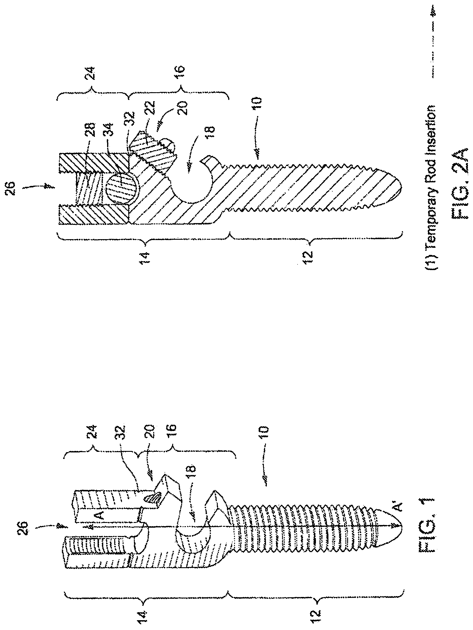 Patent US12303171 Figure 1 – Pedicle screw