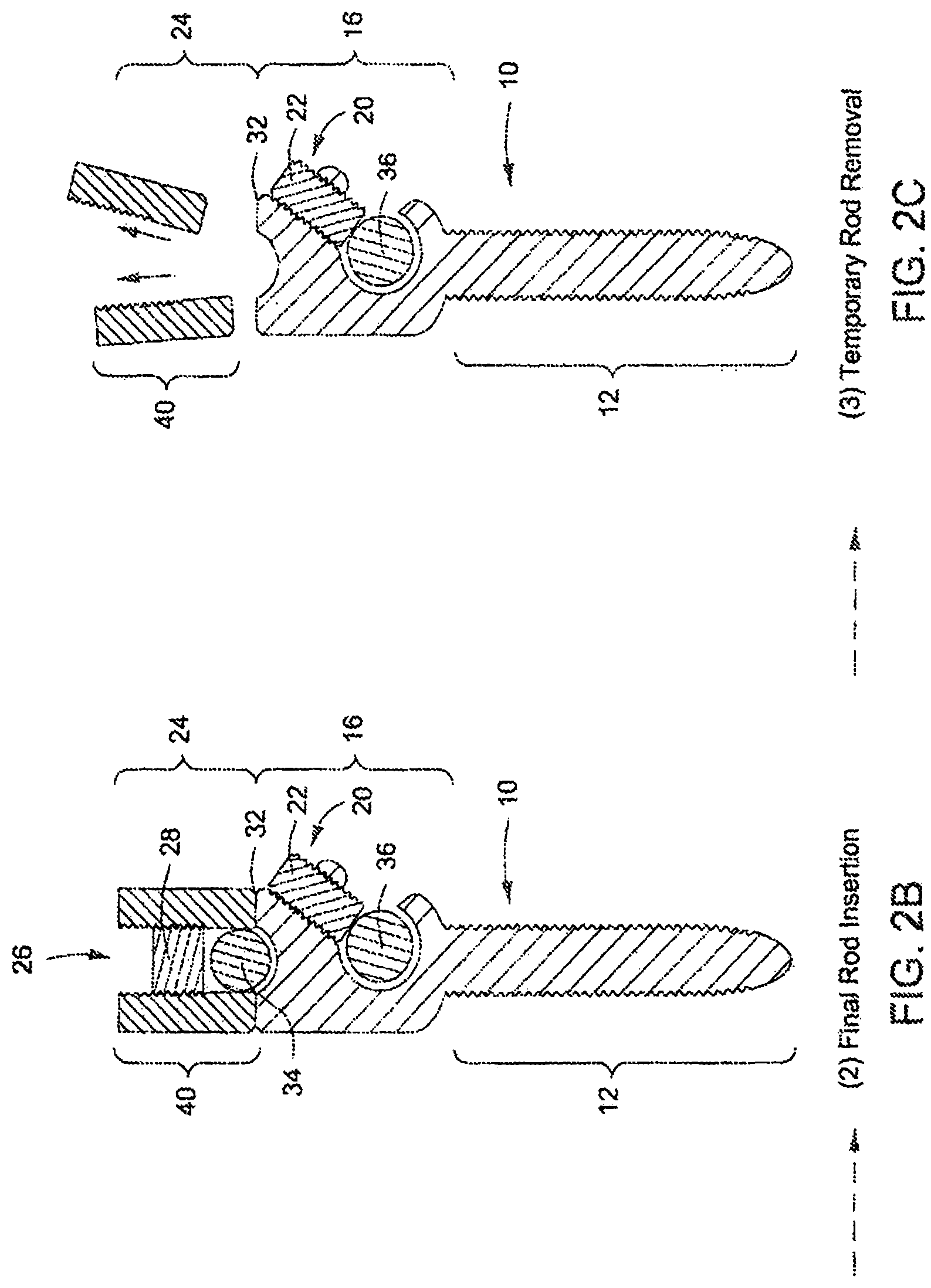 Patent US12303171 Figure 2 – Pedicle screw