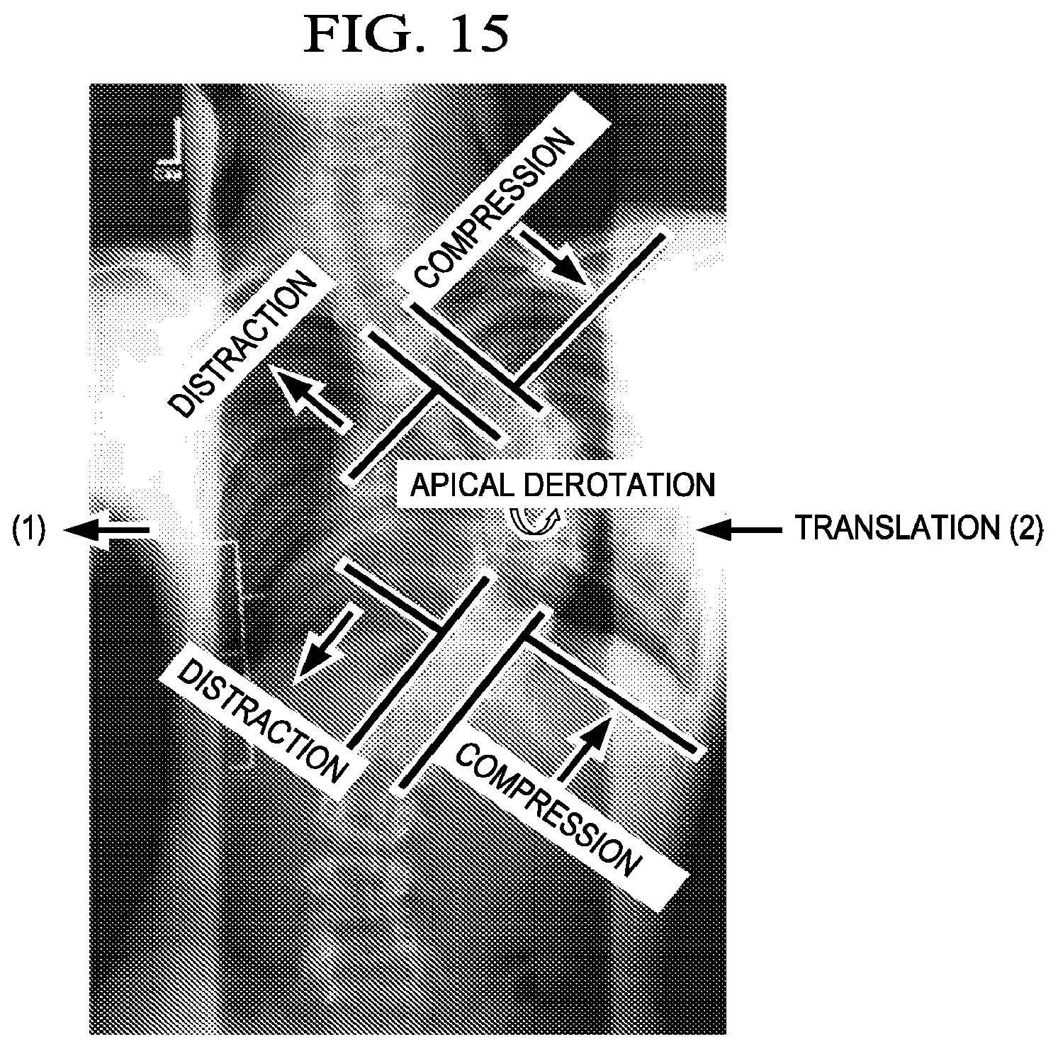 Patent US12303171 Figure 10 – Pedicle screw