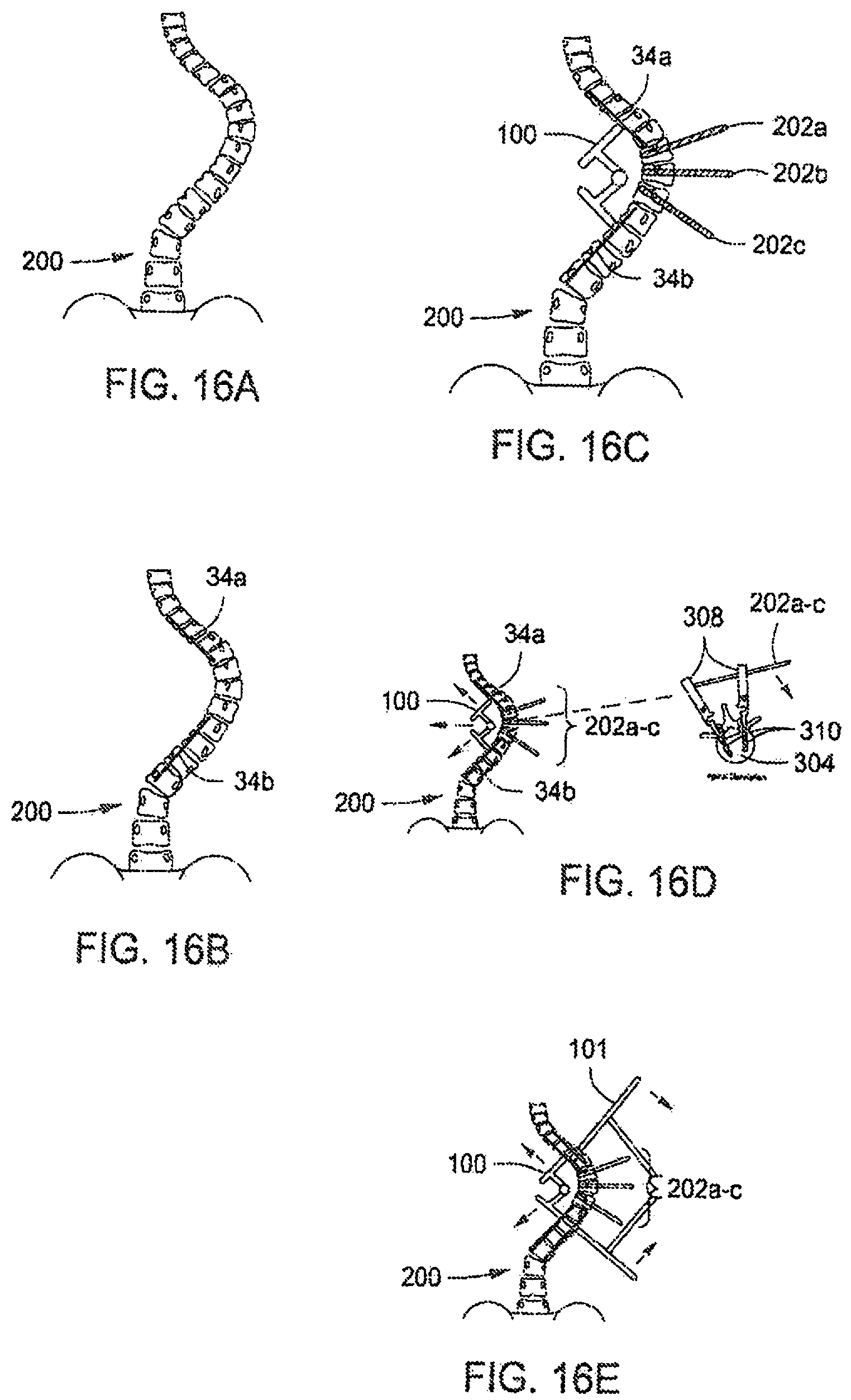 Patent US12303171 Figure 11 – Pedicle screw