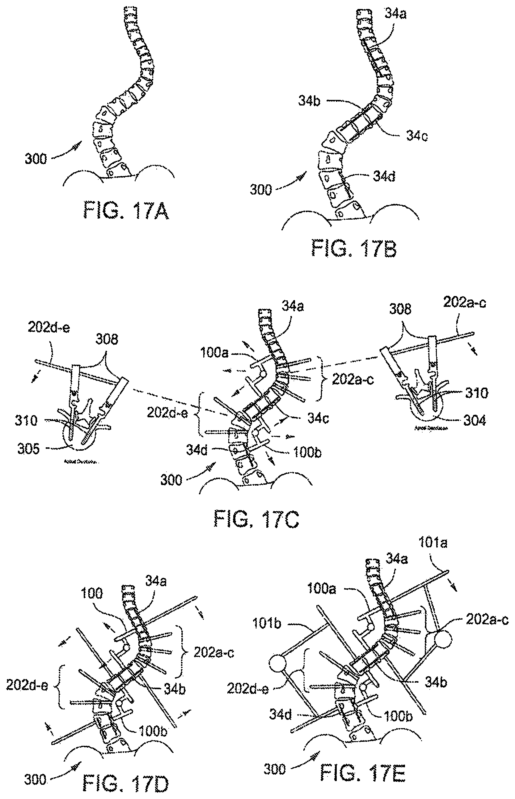 Patent US12303171 Figure 12 – Pedicle screw