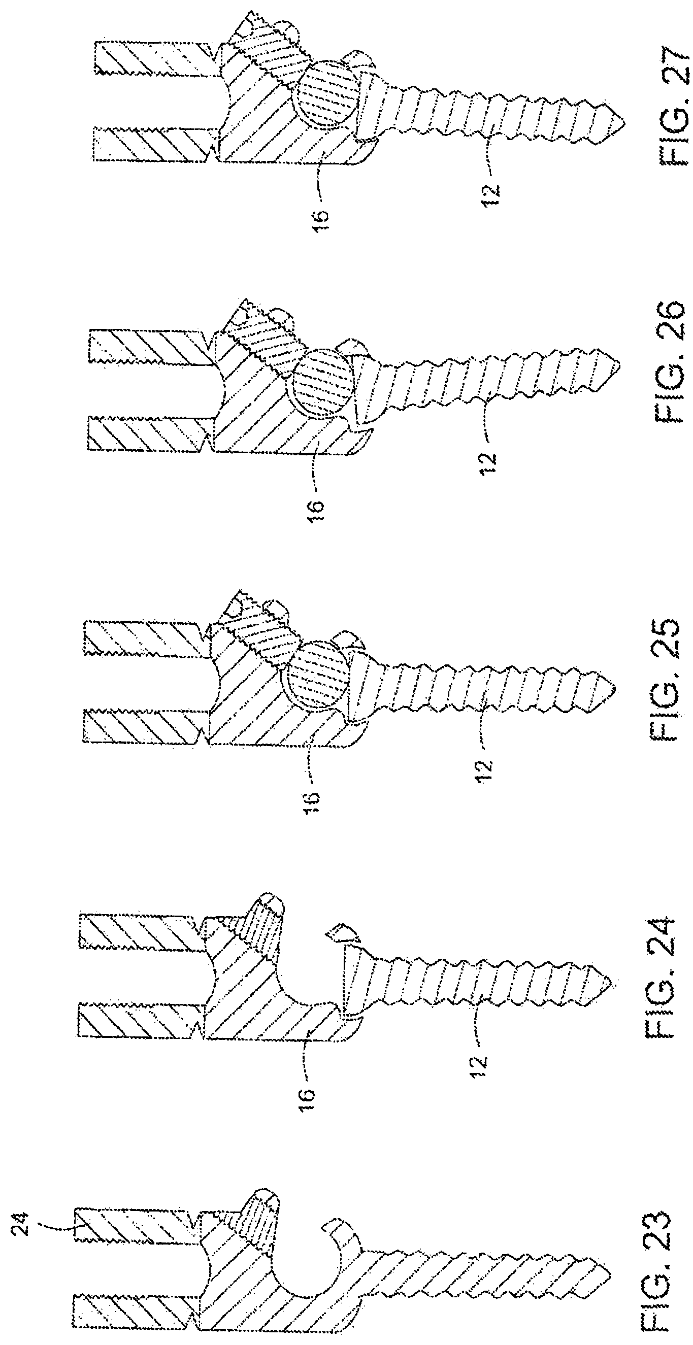 Patent US12303171 Figure 15 – Pedicle screw