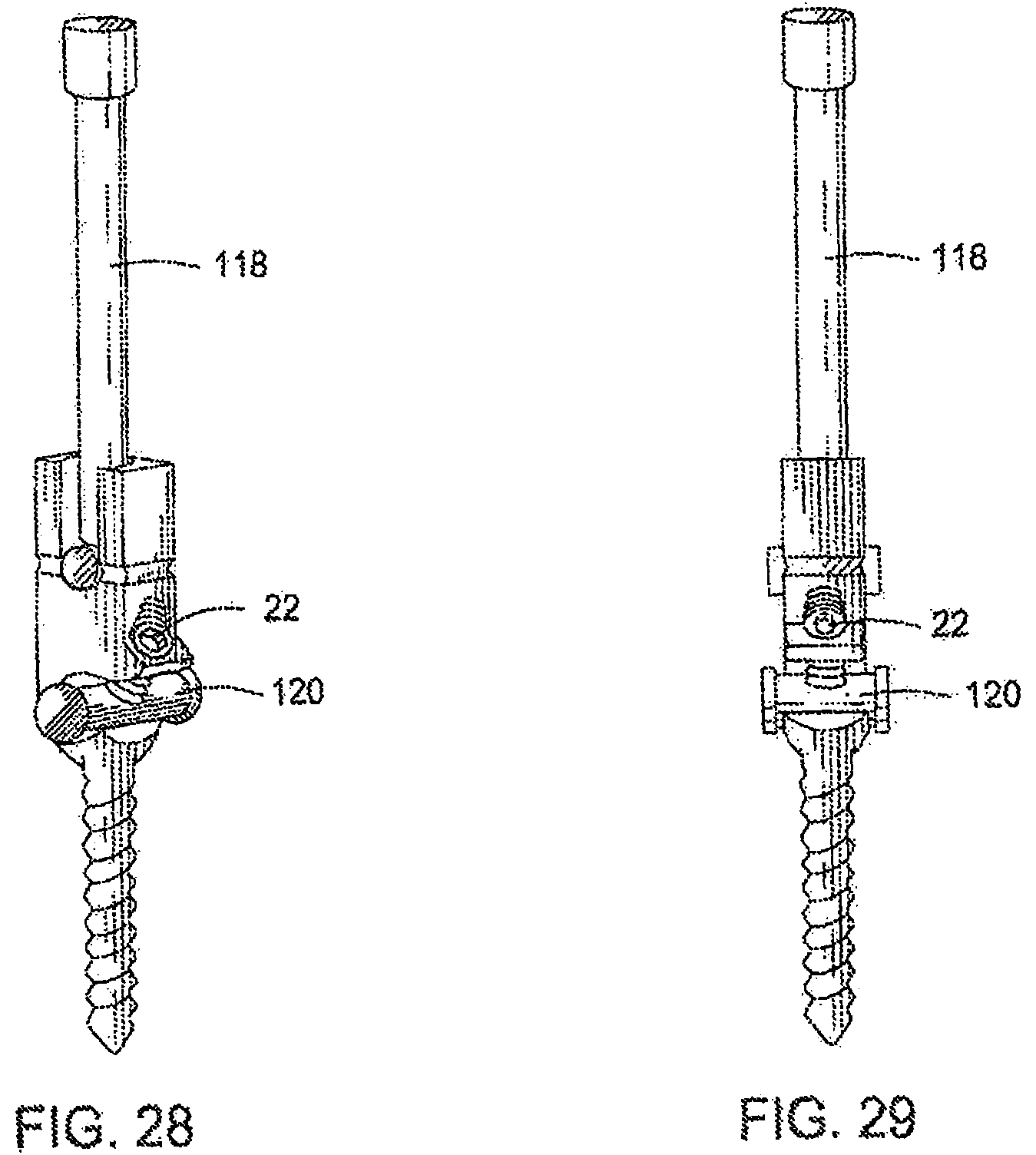 Patent US12303171 Figure 16 – Pedicle screw