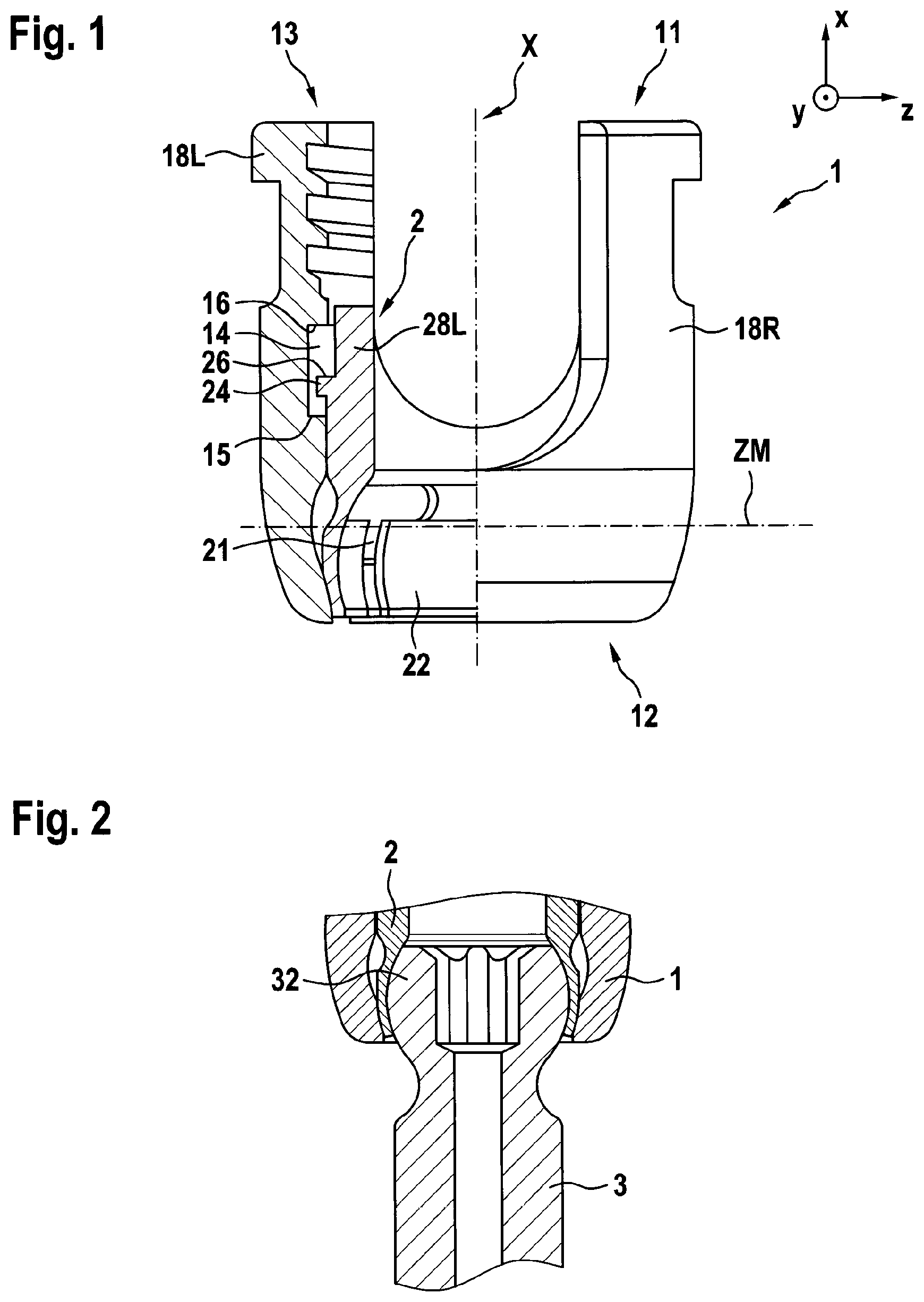 Patent US12303173 Figure 1 – Implant, in particular a spinal implant