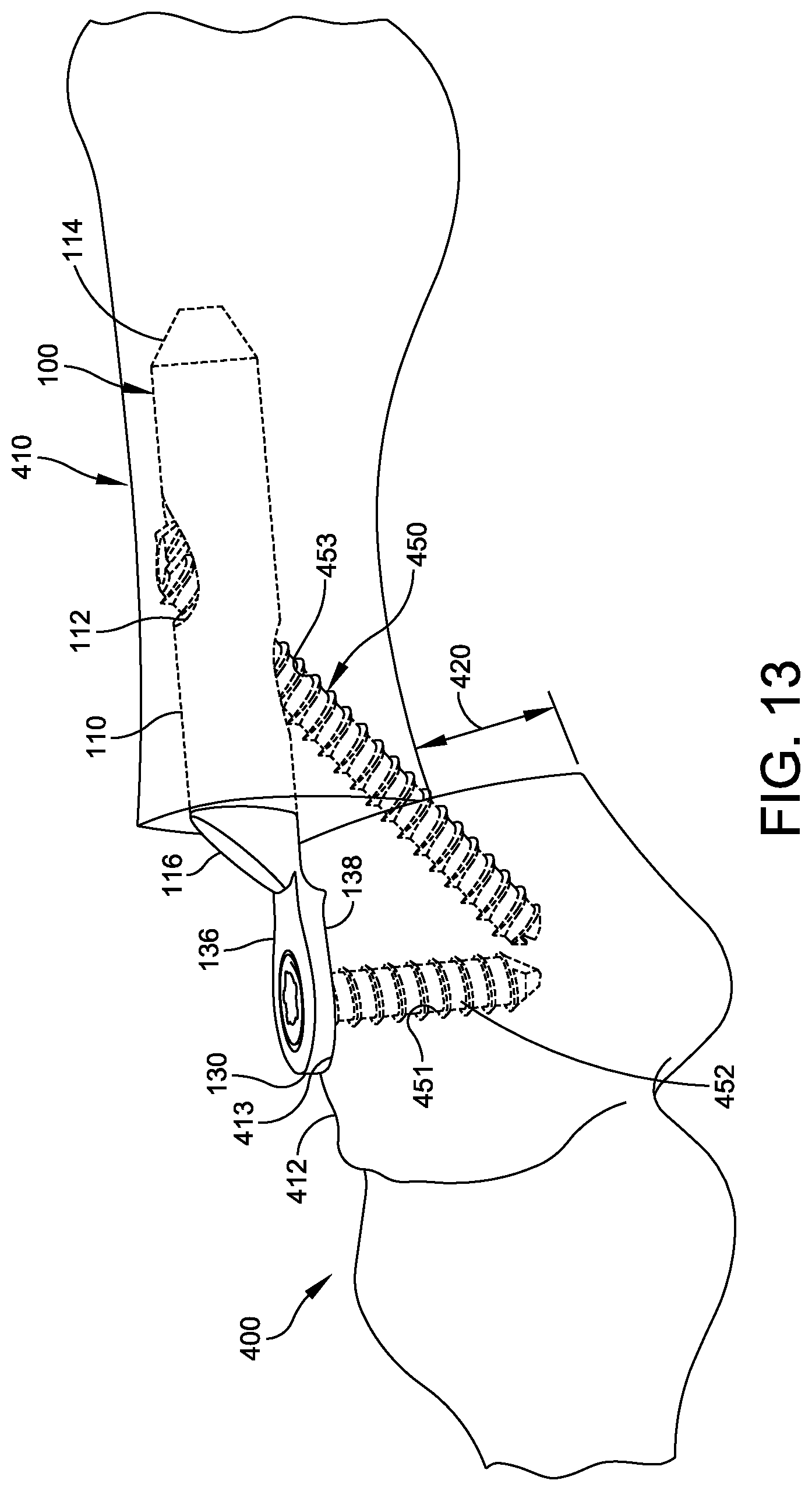 Patent US12303174 Figure 10 – Implant with intramedullary portion and variable angle extramedullary portion
