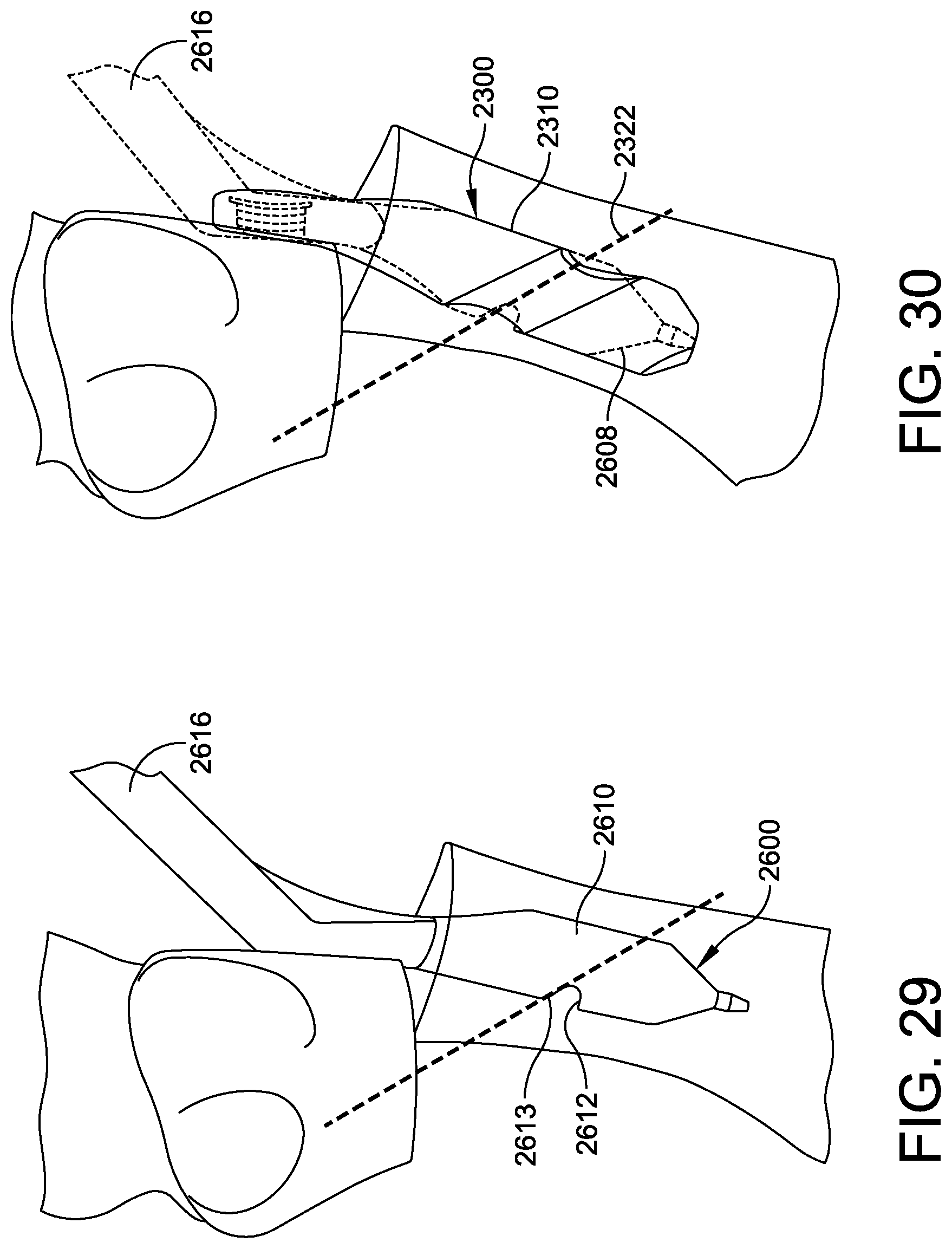 Patent US12303174 Figure 16 – Implant with intramedullary portion and variable angle extramedullary portion