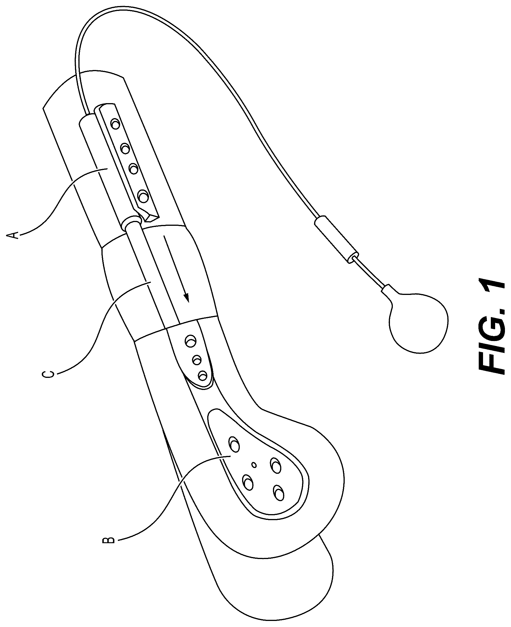 Patent US12303175 Figure 1 – Extramedullary internal bone lengthening and fixation device with dynamic axial stabilization