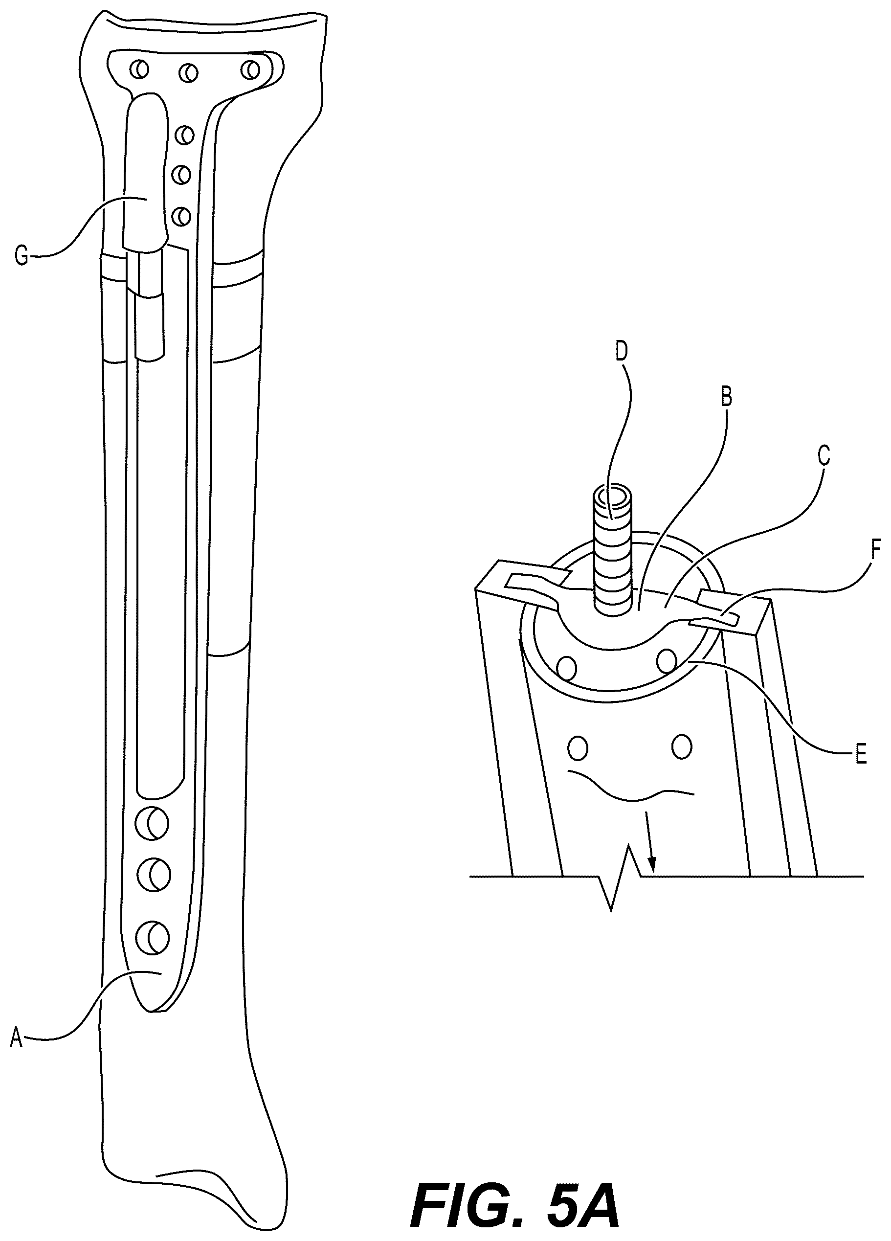 Patent US12303175 Figure 5 – Extramedullary internal bone lengthening and fixation device with dynamic axial stabilization