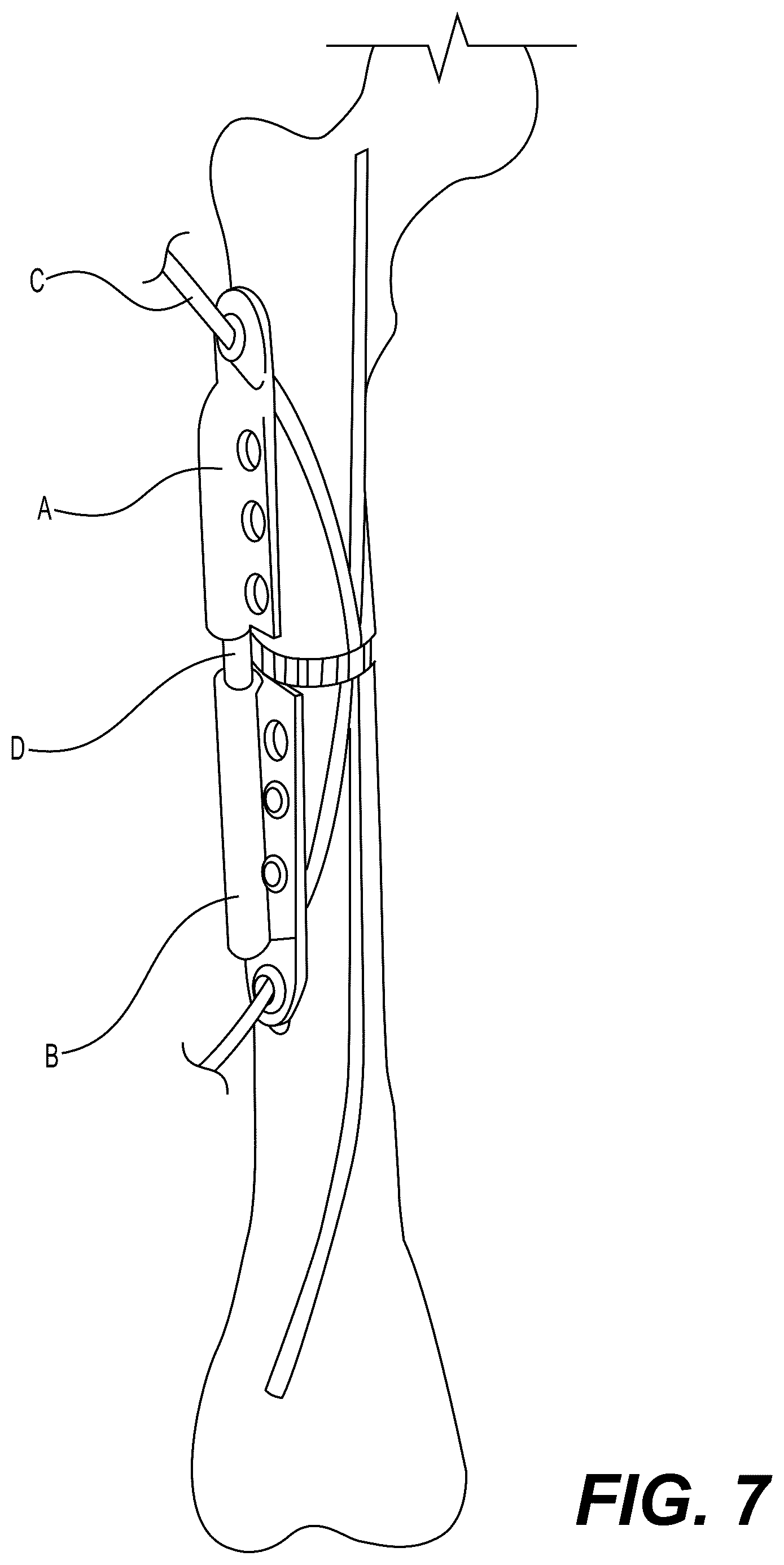 Patent US12303175 Figure 10 – Extramedullary internal bone lengthening and fixation device with dynamic axial stabilization
