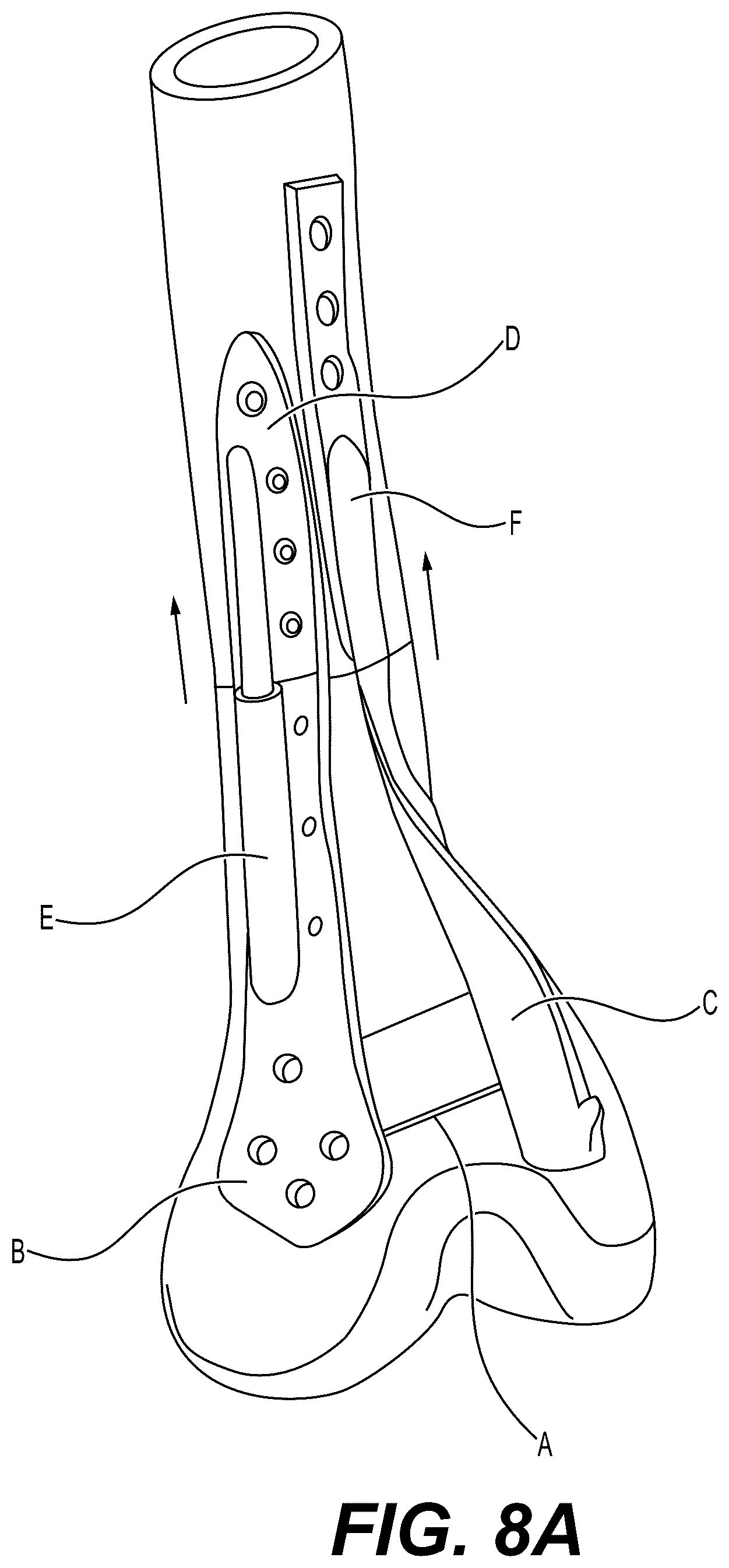 Patent US12303175 Figure 11 – Extramedullary internal bone lengthening and fixation device with dynamic axial stabilization