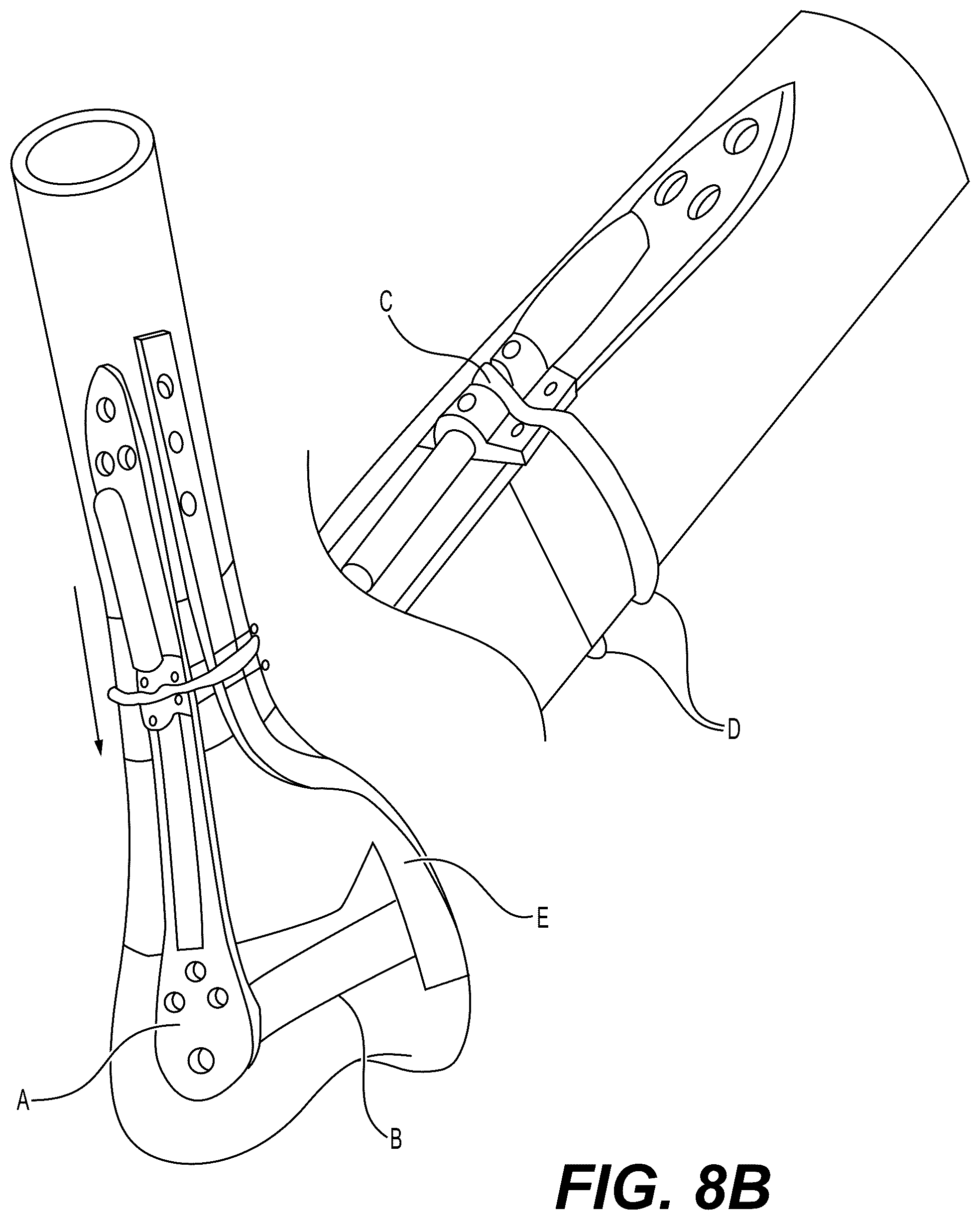 Patent US12303175 Figure 12 – Extramedullary internal bone lengthening and fixation device with dynamic axial stabilization