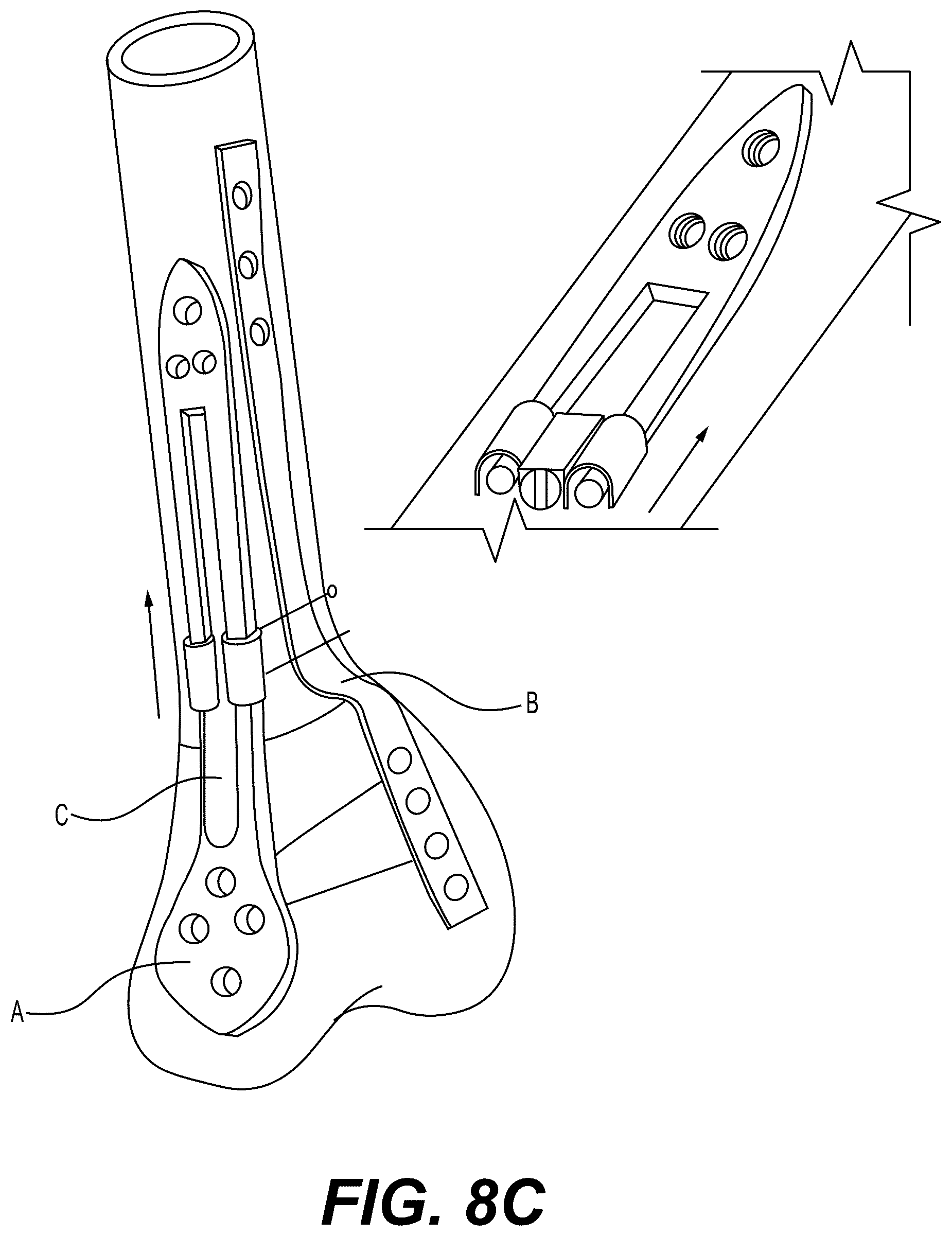 Patent US12303175 Figure 13 – Extramedullary internal bone lengthening and fixation device with dynamic axial stabilization