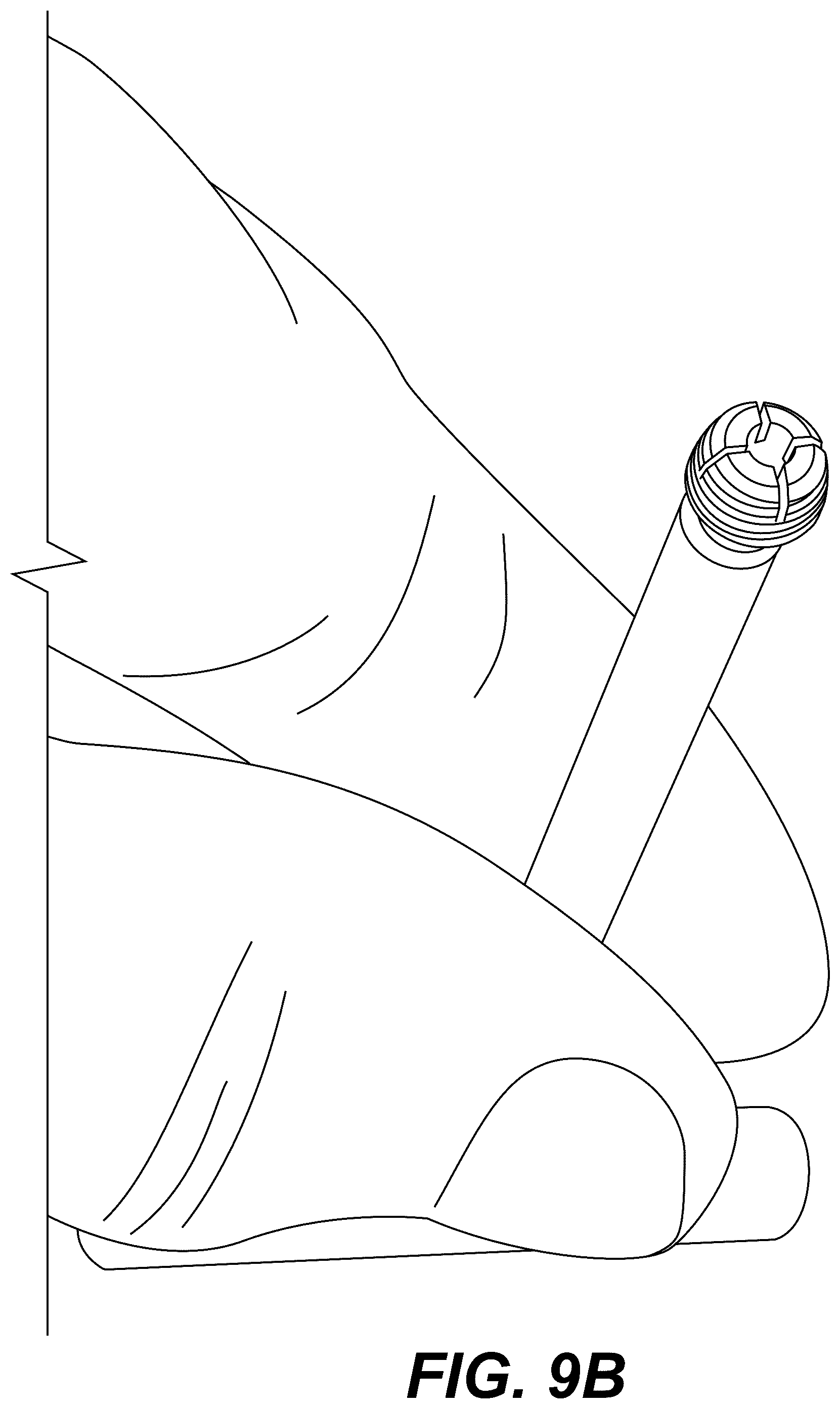 Patent US12303175 Figure 15 – Extramedullary internal bone lengthening and fixation device with dynamic axial stabilization