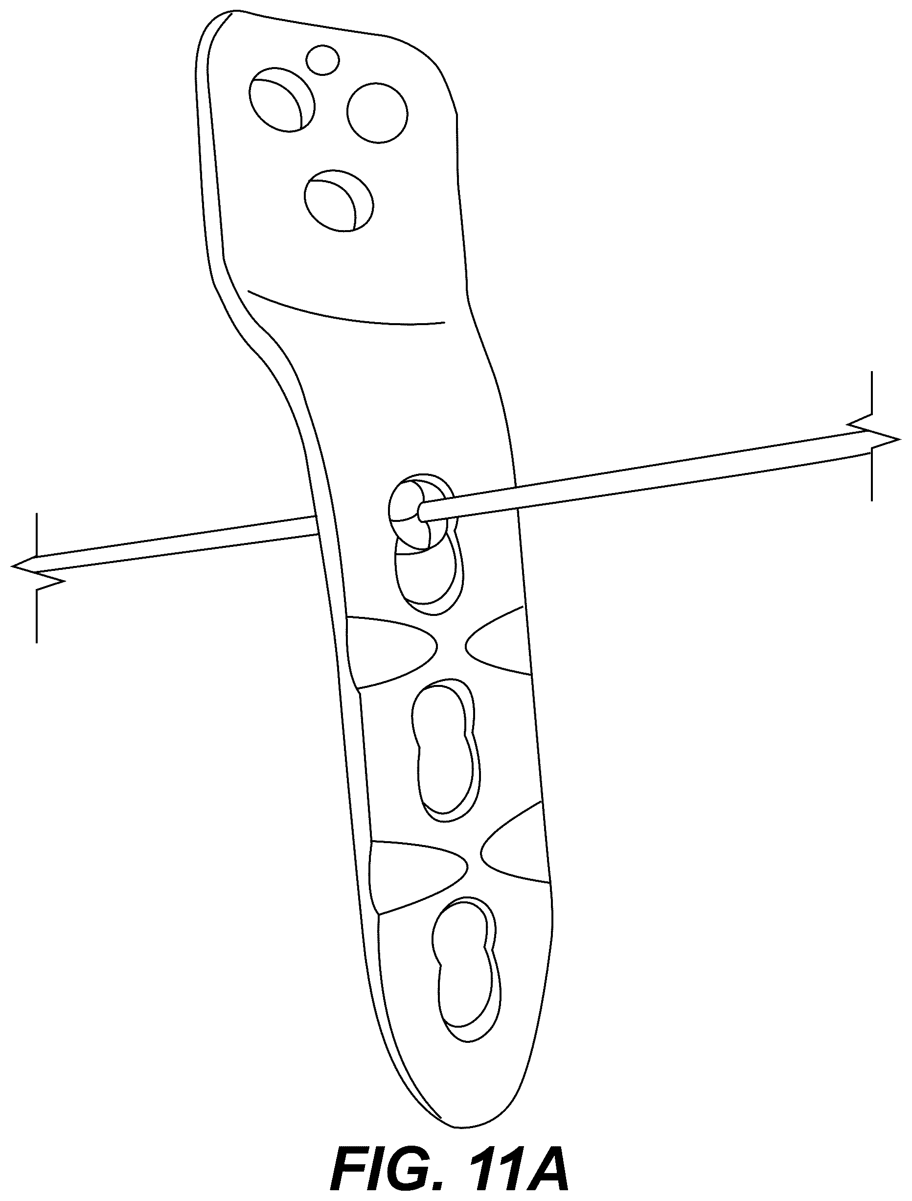 Patent US12303175 Figure 17 – Extramedullary internal bone lengthening and fixation device with dynamic axial stabilization