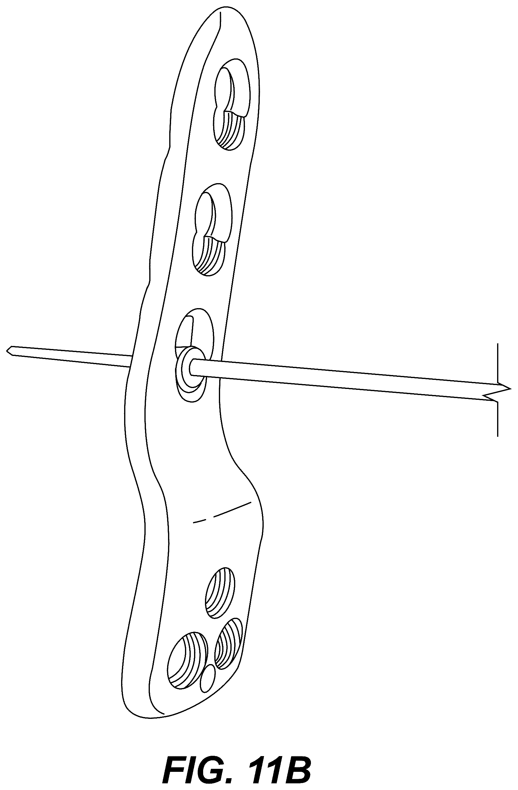 Patent US12303175 Figure 18 – Extramedullary internal bone lengthening and fixation device with dynamic axial stabilization