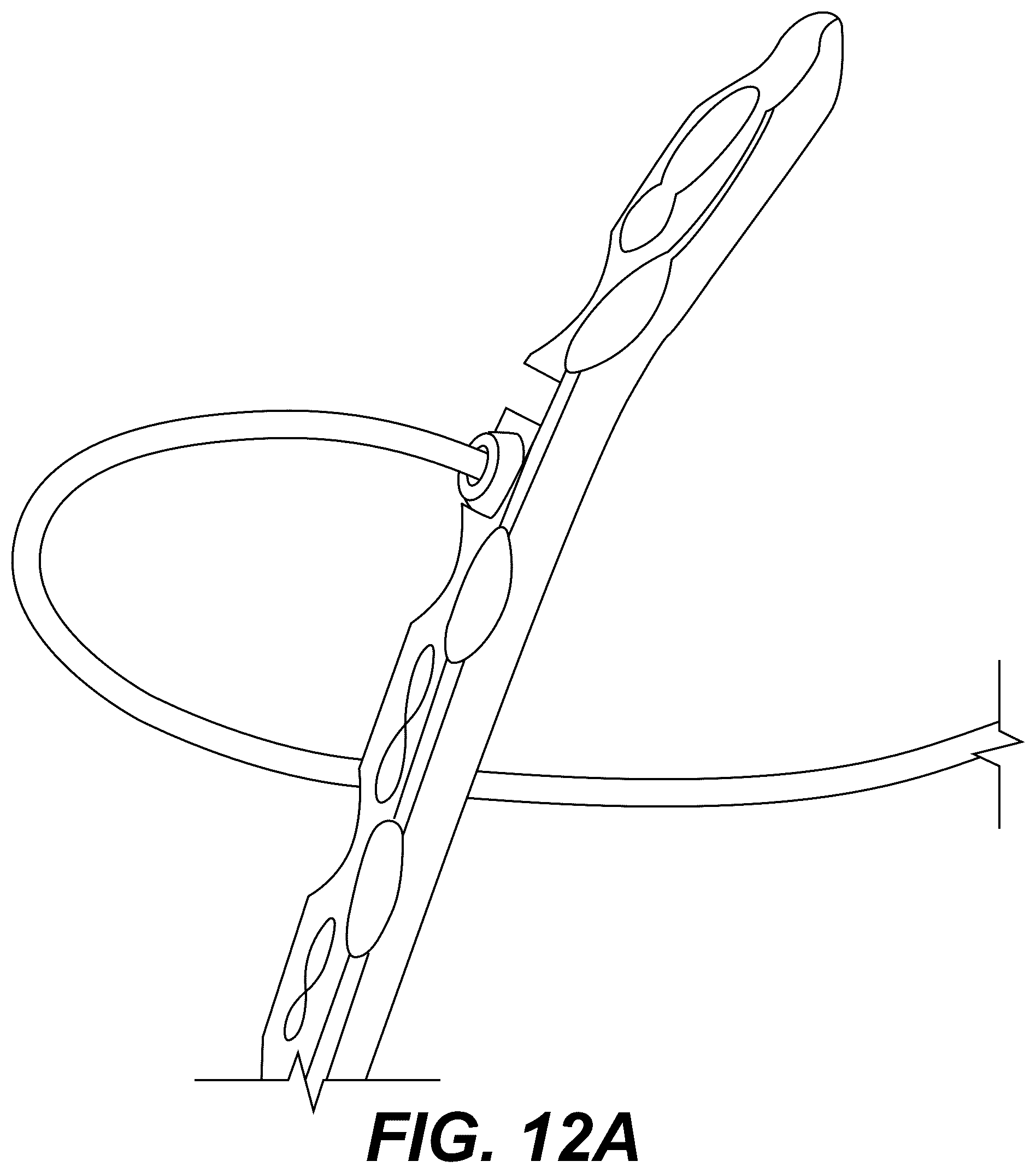Patent US12303175 Figure 19 – Extramedullary internal bone lengthening and fixation device with dynamic axial stabilization