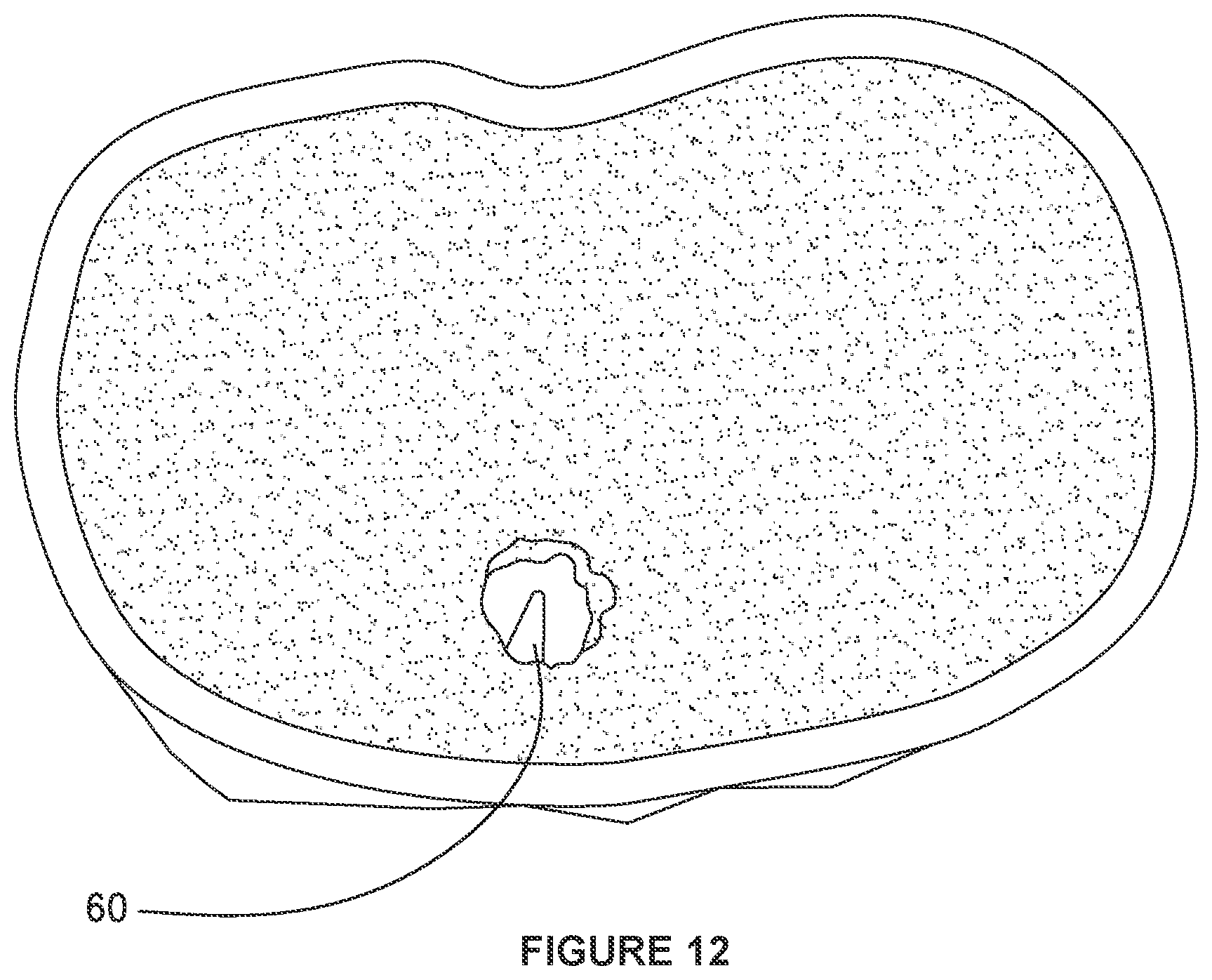 Patent US12303178 Figure 12 – Systems and methods for determining the cure of PMMA intraoperatively after implantation of an orthopedic device