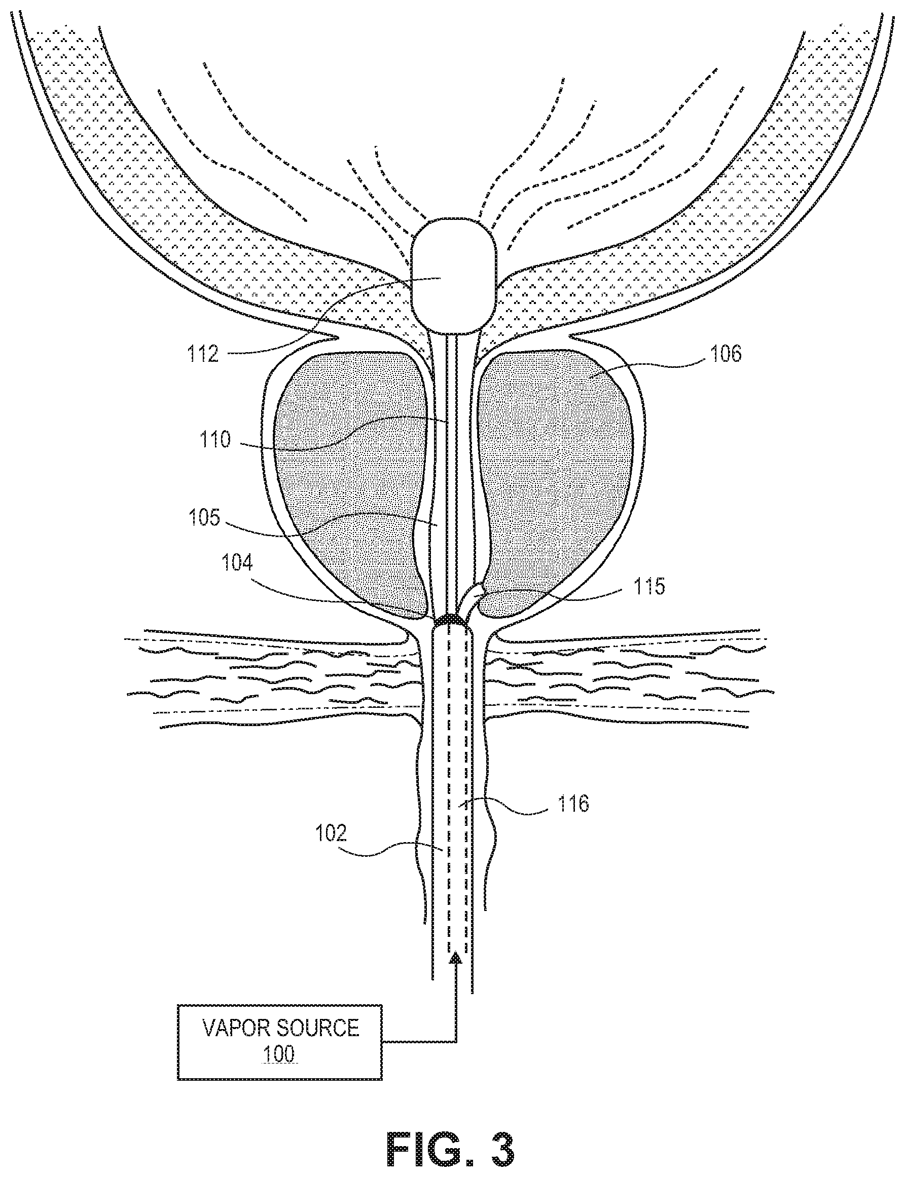 Patent US12303181 Figure 3 – Systems and methods for treatment of prostatic tissue