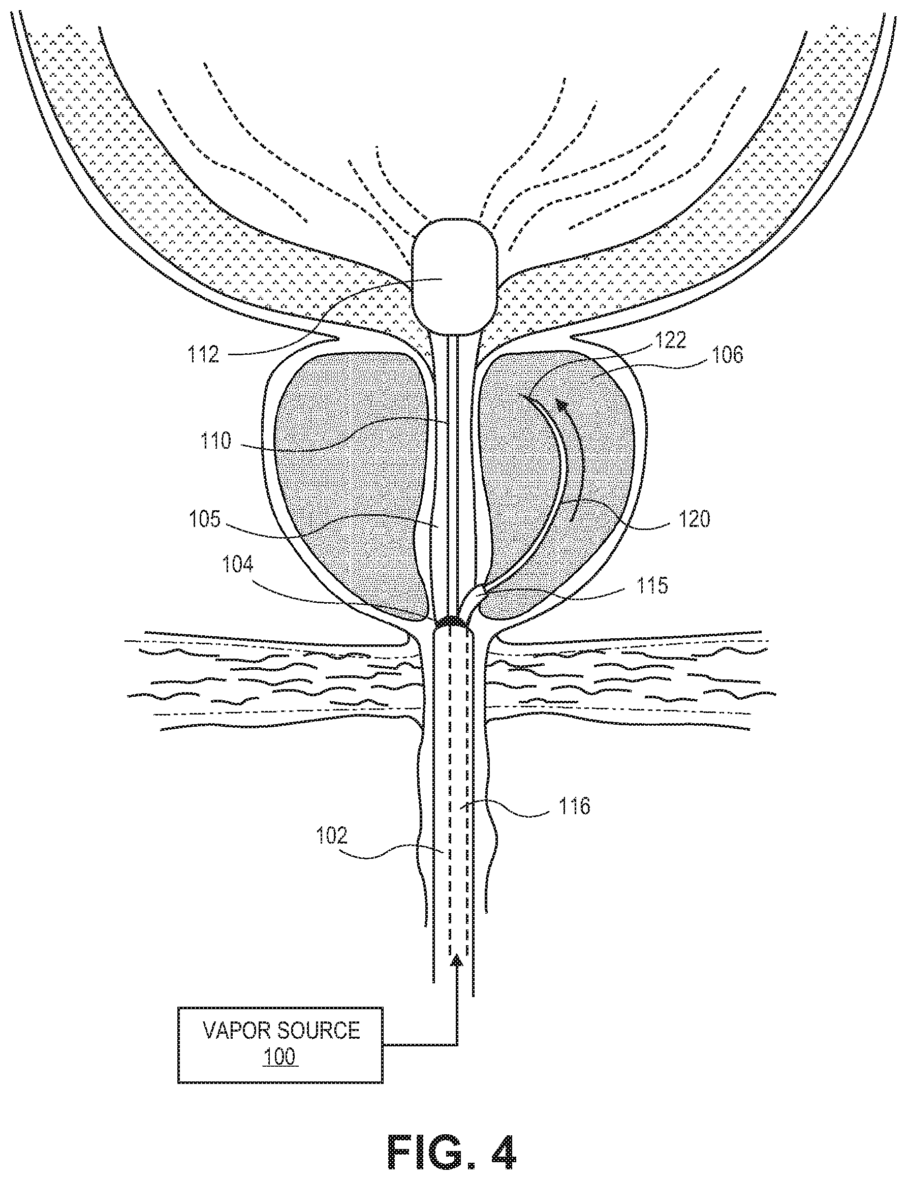 Patent US12303181 Figure 4 – Systems and methods for treatment of prostatic tissue