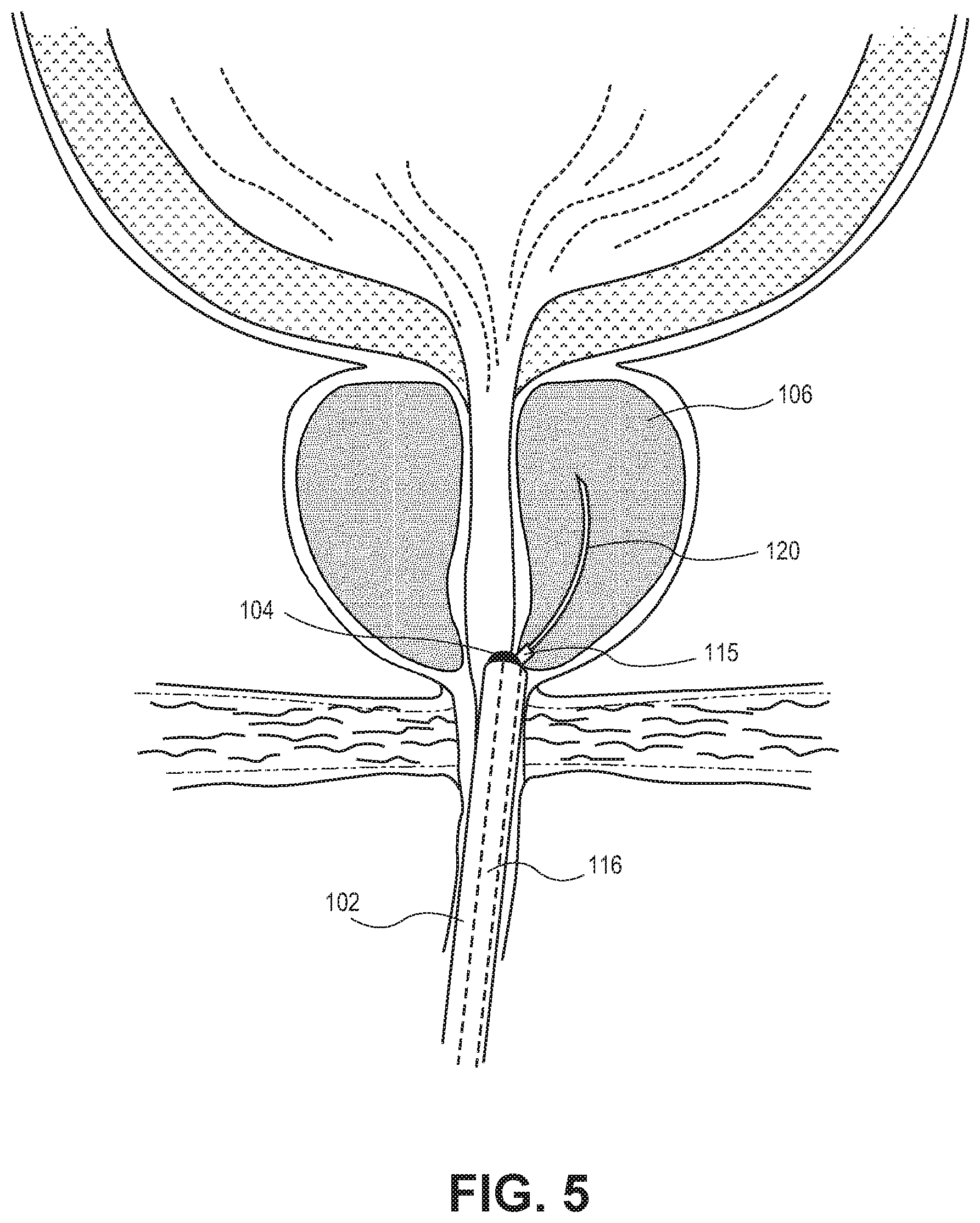 Patent US12303181 Figure 5 – Systems and methods for treatment of prostatic tissue