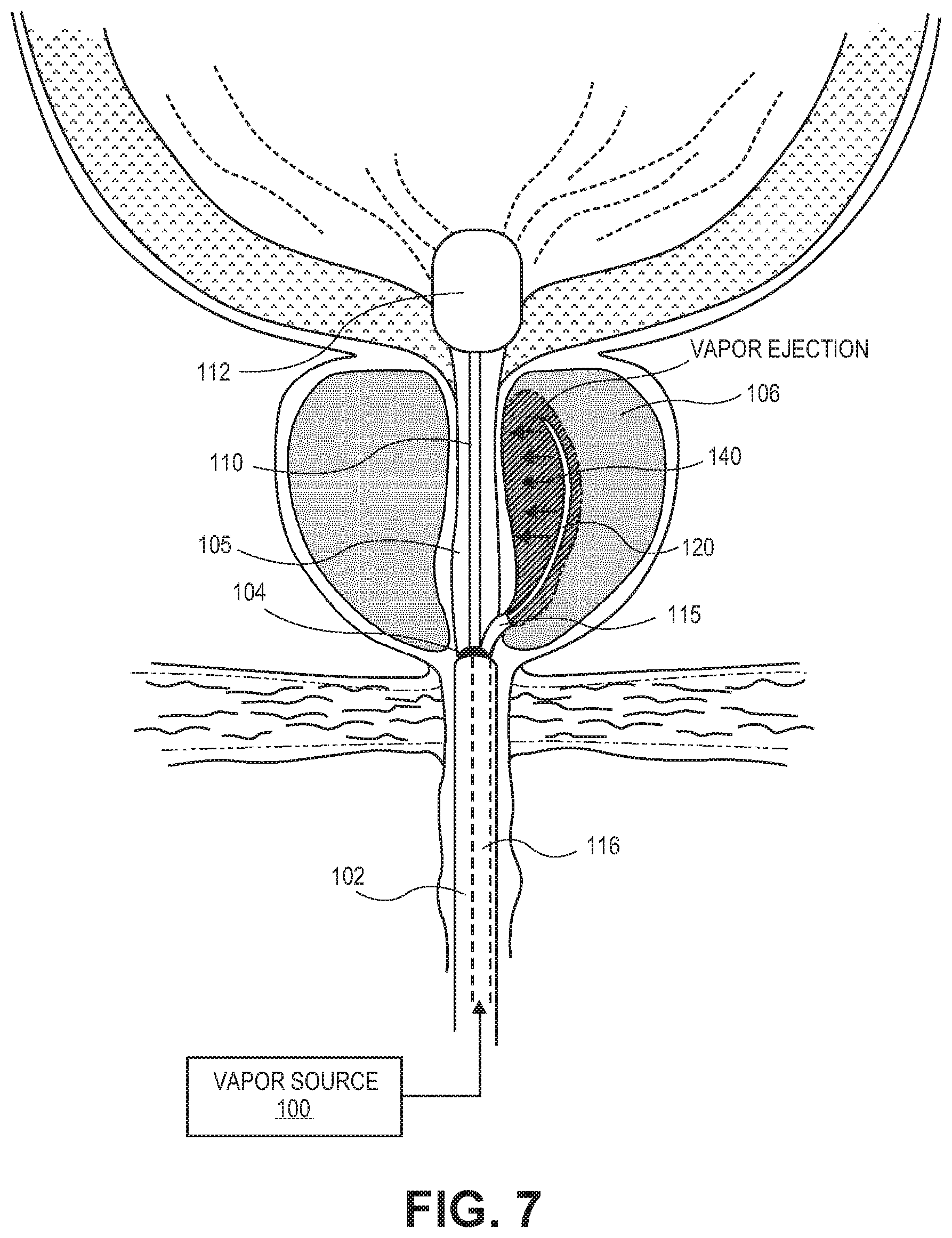 Patent US12303181 Figure 7 – Systems and methods for treatment of prostatic tissue