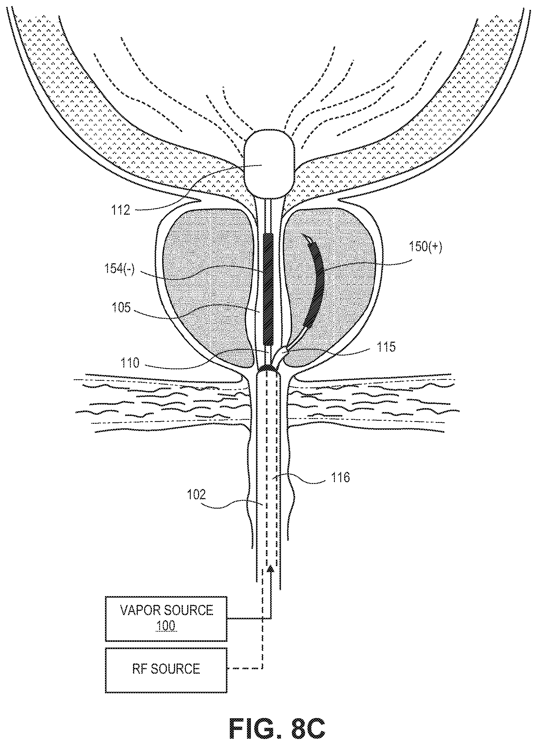 Patent US12303181 Figure 9 – Systems and methods for treatment of prostatic tissue