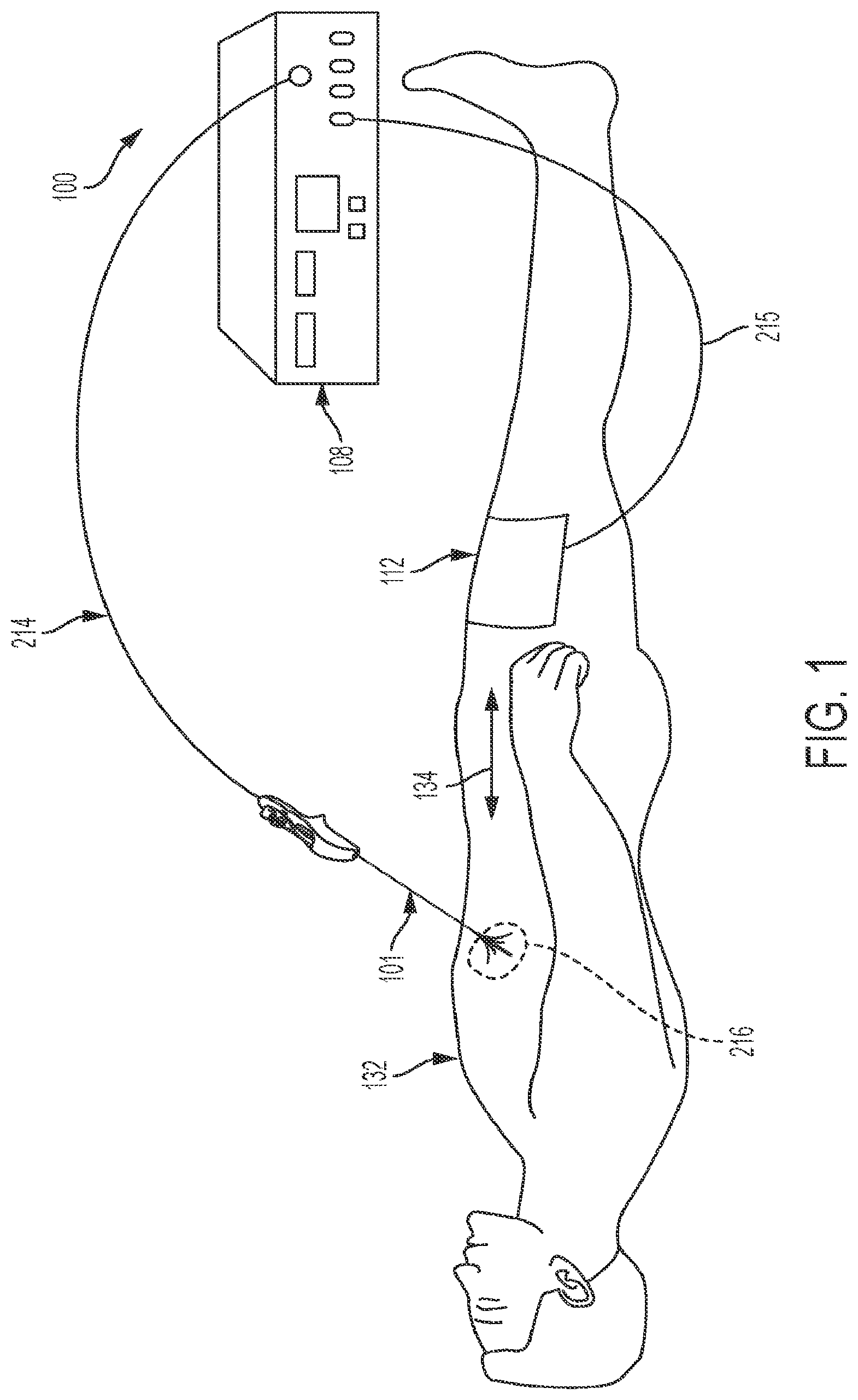 Patent US12303182 Figure 1 – Techniques for irreversible electroporation using a single-pole tine-style internal device communicating with an external surface electrode