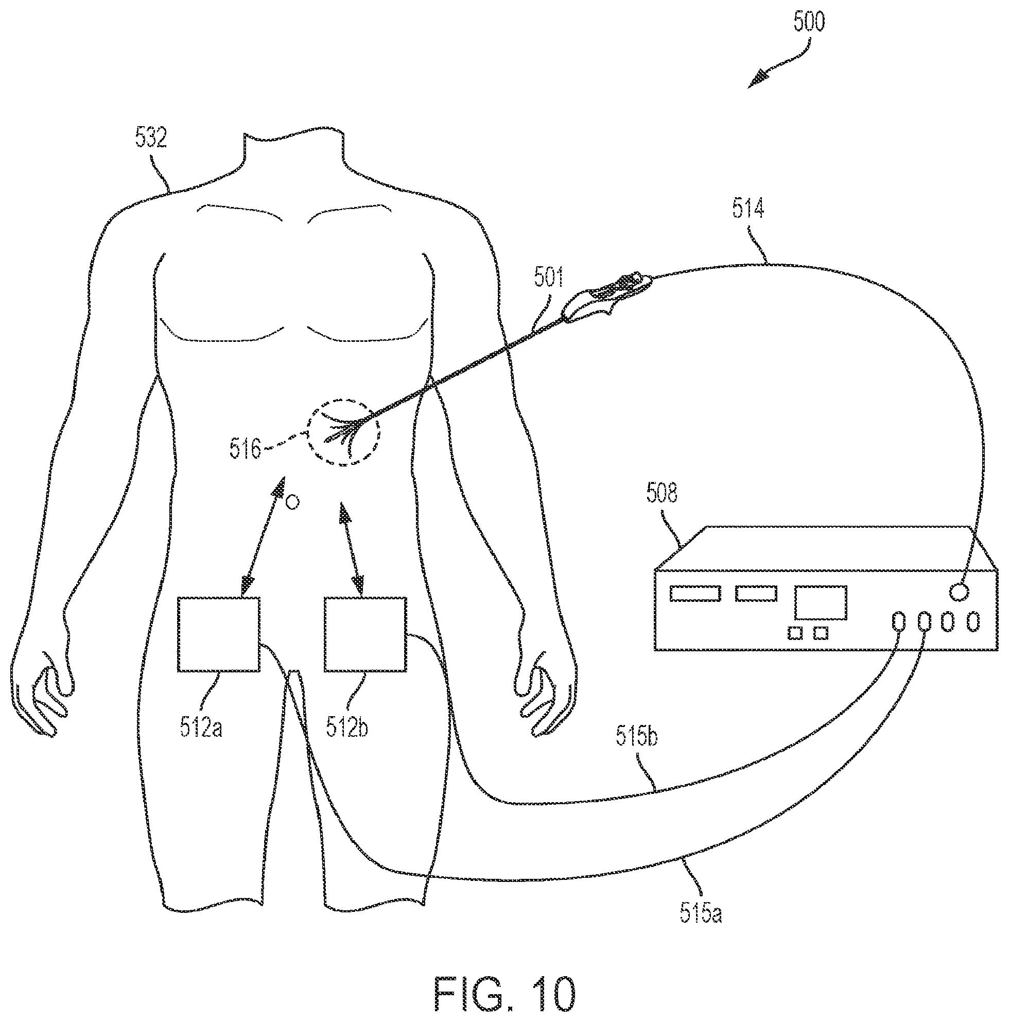 Patent US12303182 Figure 9 – Techniques for irreversible electroporation using a single-pole tine-style internal device communicating with an external surface electrode