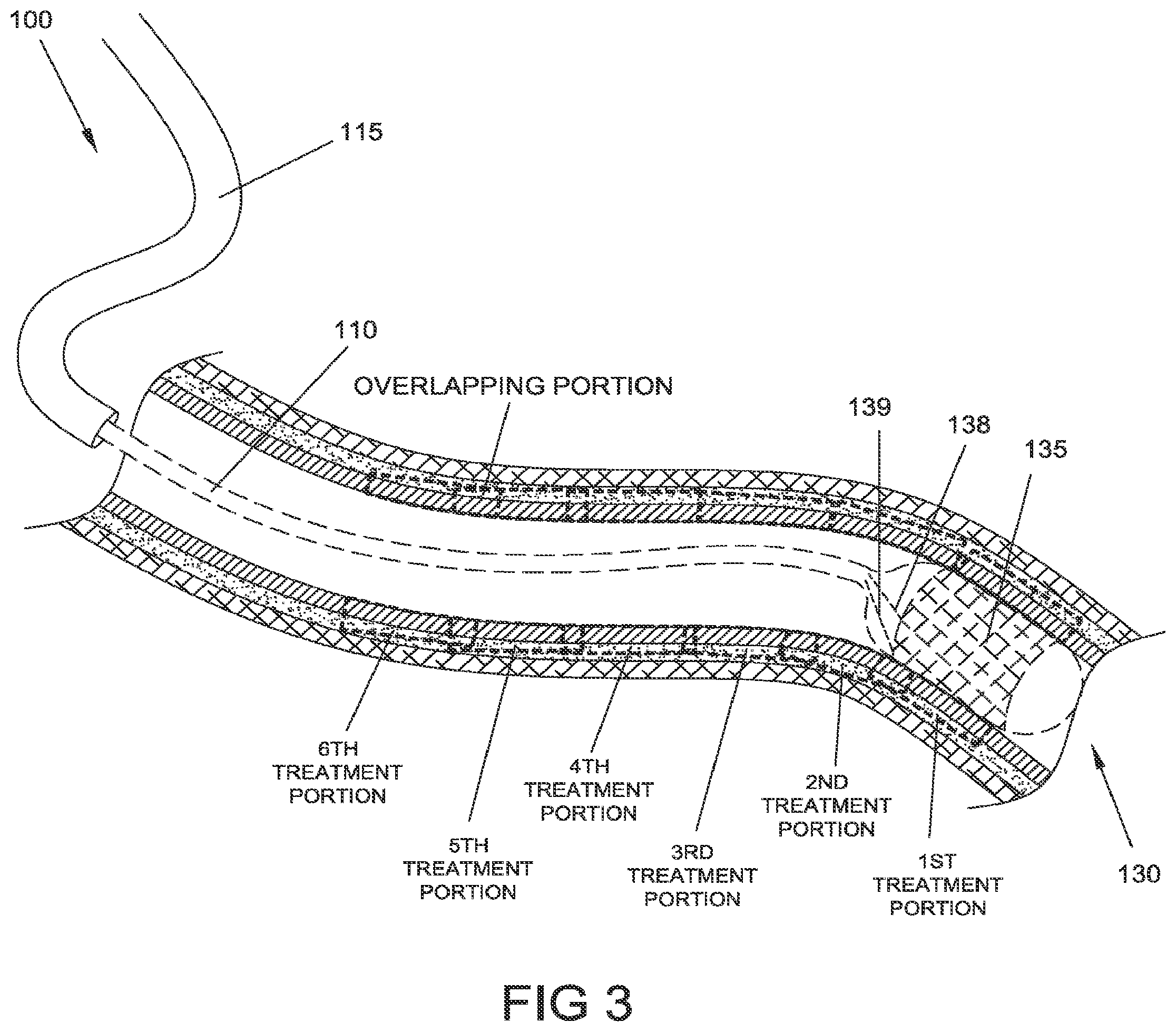 Patent US12303185 Figure 3 – Electrical energy ablation systems, devices and methods for the treatment of tissue