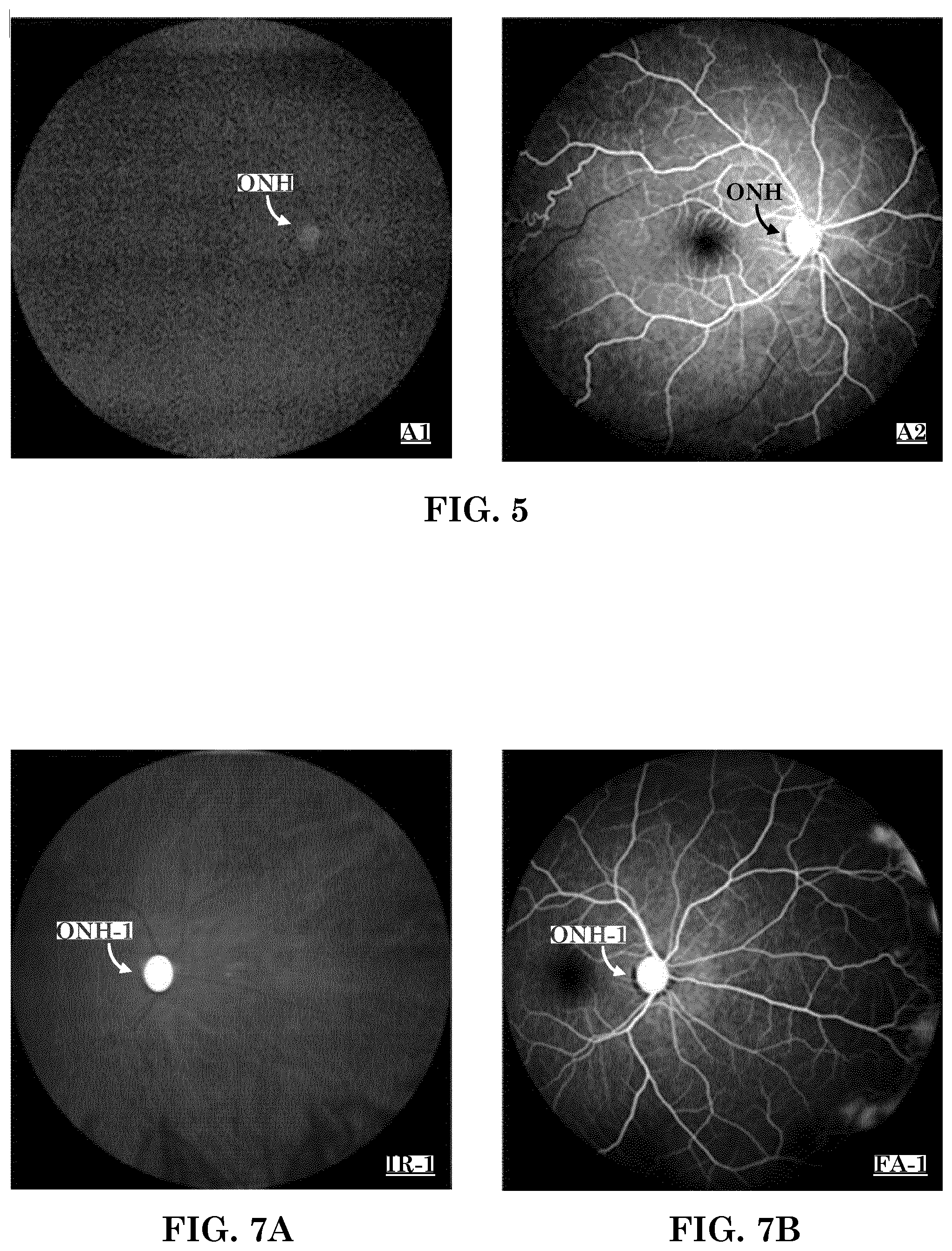 Patent US12303197 Figure 3 – Patient tuned ophthalmic imaging system with single exposure multi-type imaging, improved focusing, and improved angiography image sequence display