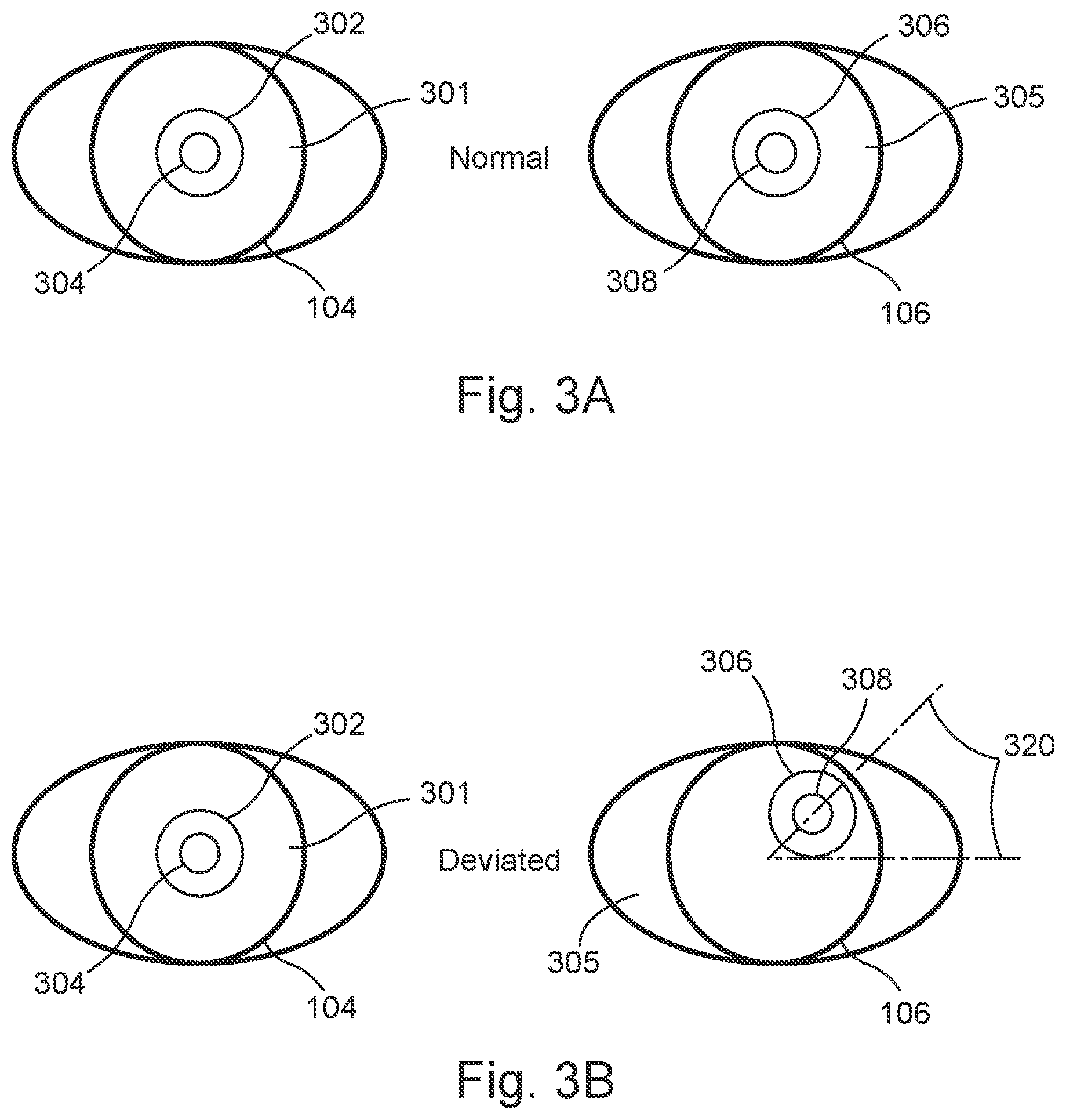 Patent US12303201 Figure 5 – System and device for promoting eye alignment