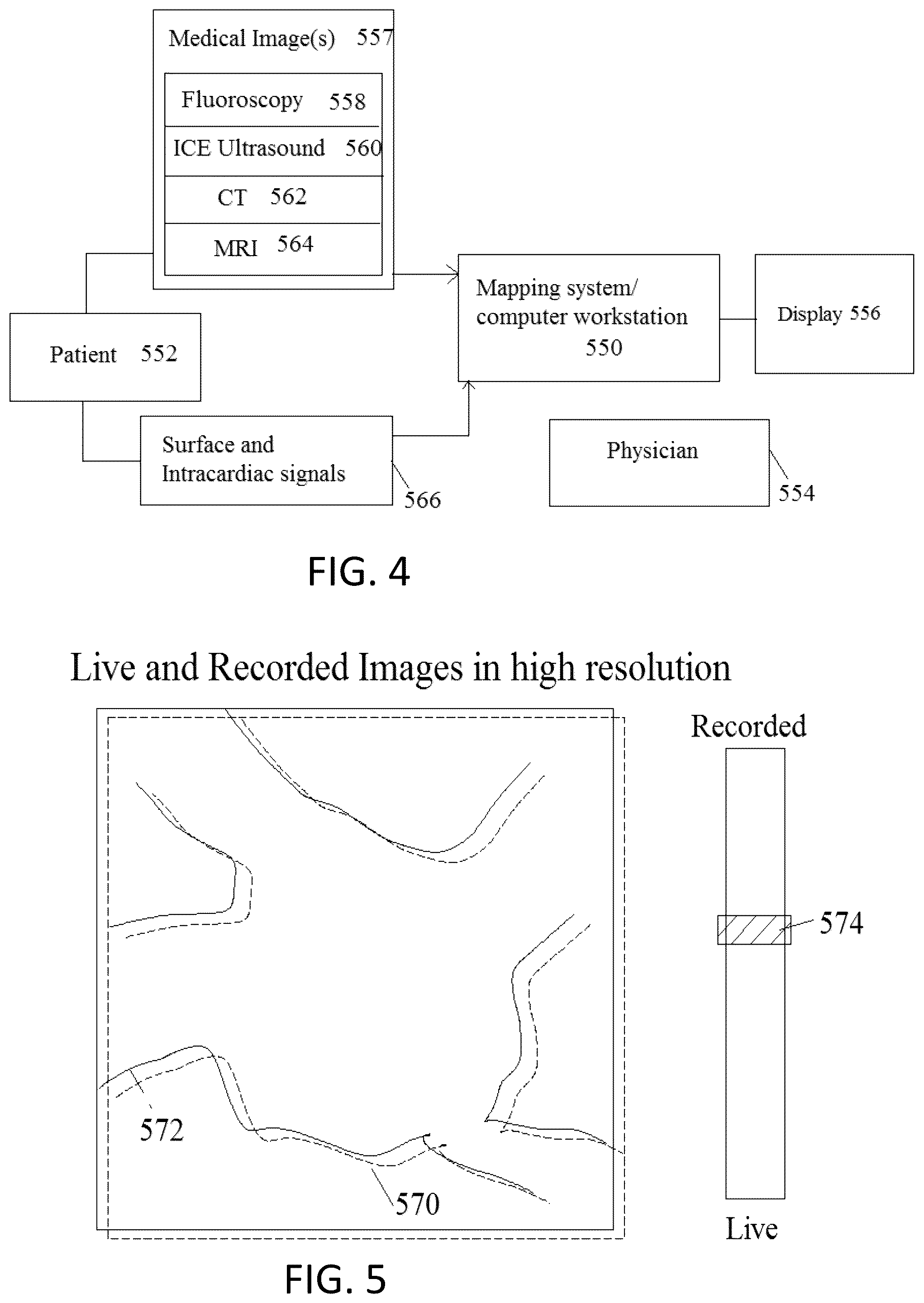 Patent US12303203 Figure 5 – Methods and system for atrial fibrillation ablation using balloon based catheters and utilizing medical images (CT or MRI in segments) based cardiac mapping and/or utilizing virtual reality (VR), and/or augmented reality (AR), and/or mixed reality (MR) for aiding in cardiac procedures