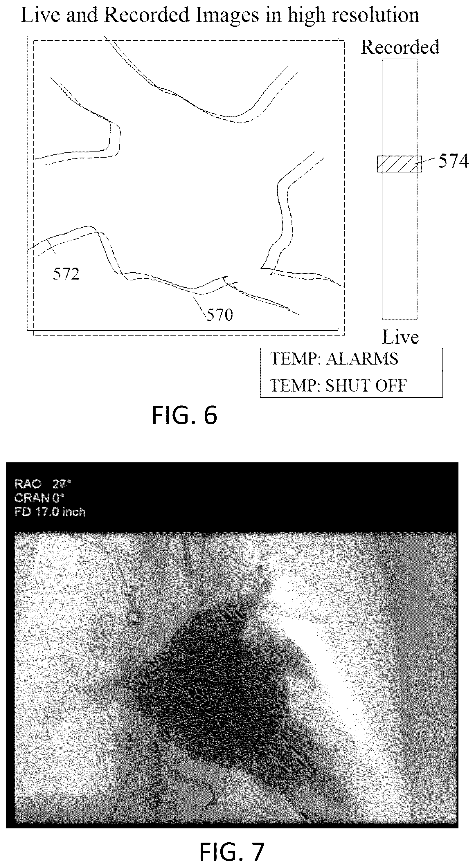 Patent US12303203 Figure 6 – Methods and system for atrial fibrillation ablation using balloon based catheters and utilizing medical images (CT or MRI in segments) based cardiac mapping and/or utilizing virtual reality (VR), and/or augmented reality (AR), and/or mixed reality (MR) for aiding in cardiac procedures