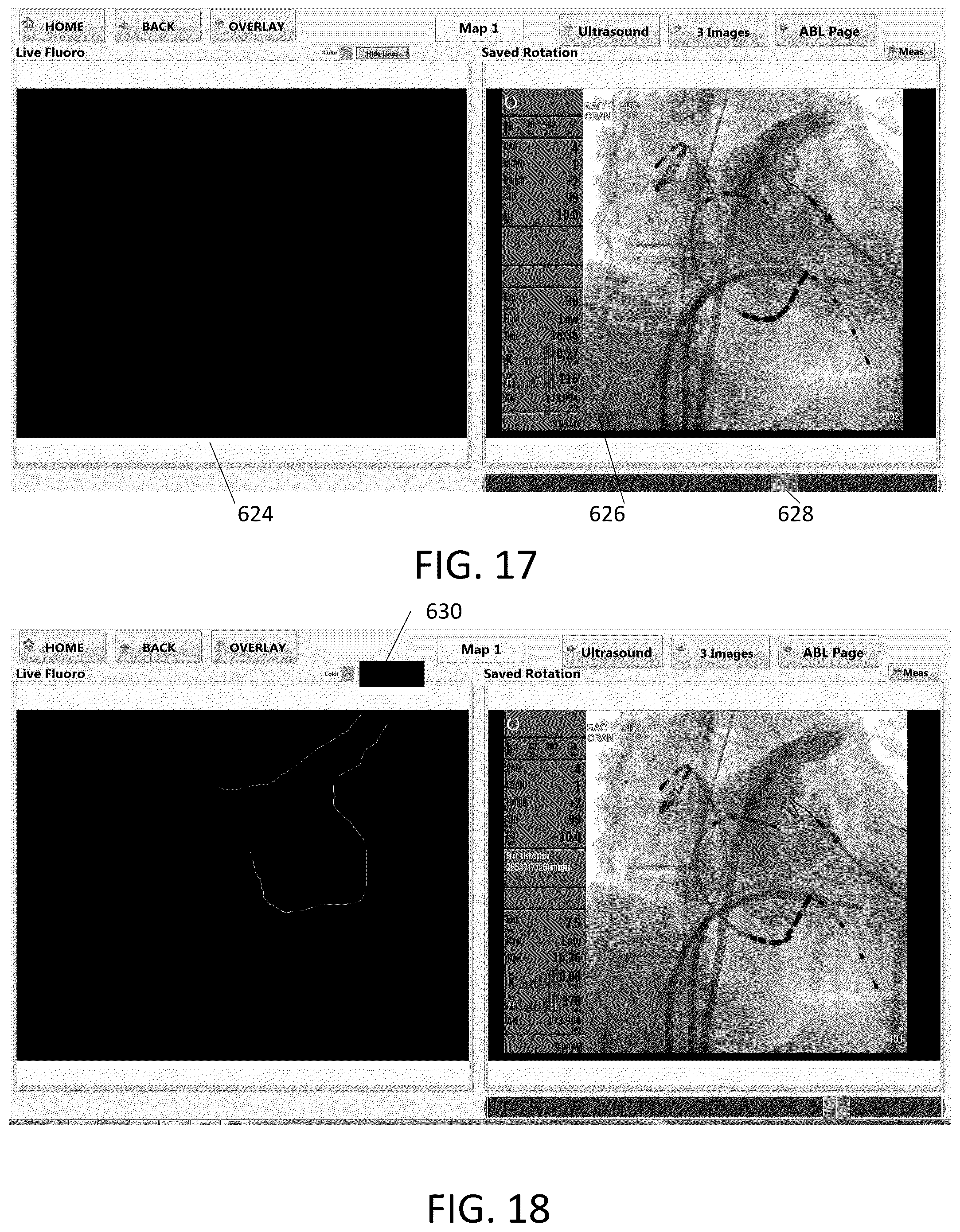 Patent US12303203 Figure 9 – Methods and system for atrial fibrillation ablation using balloon based catheters and utilizing medical images (CT or MRI in segments) based cardiac mapping and/or utilizing virtual reality (VR), and/or augmented reality (AR), and/or mixed reality (MR) for aiding in cardiac procedures