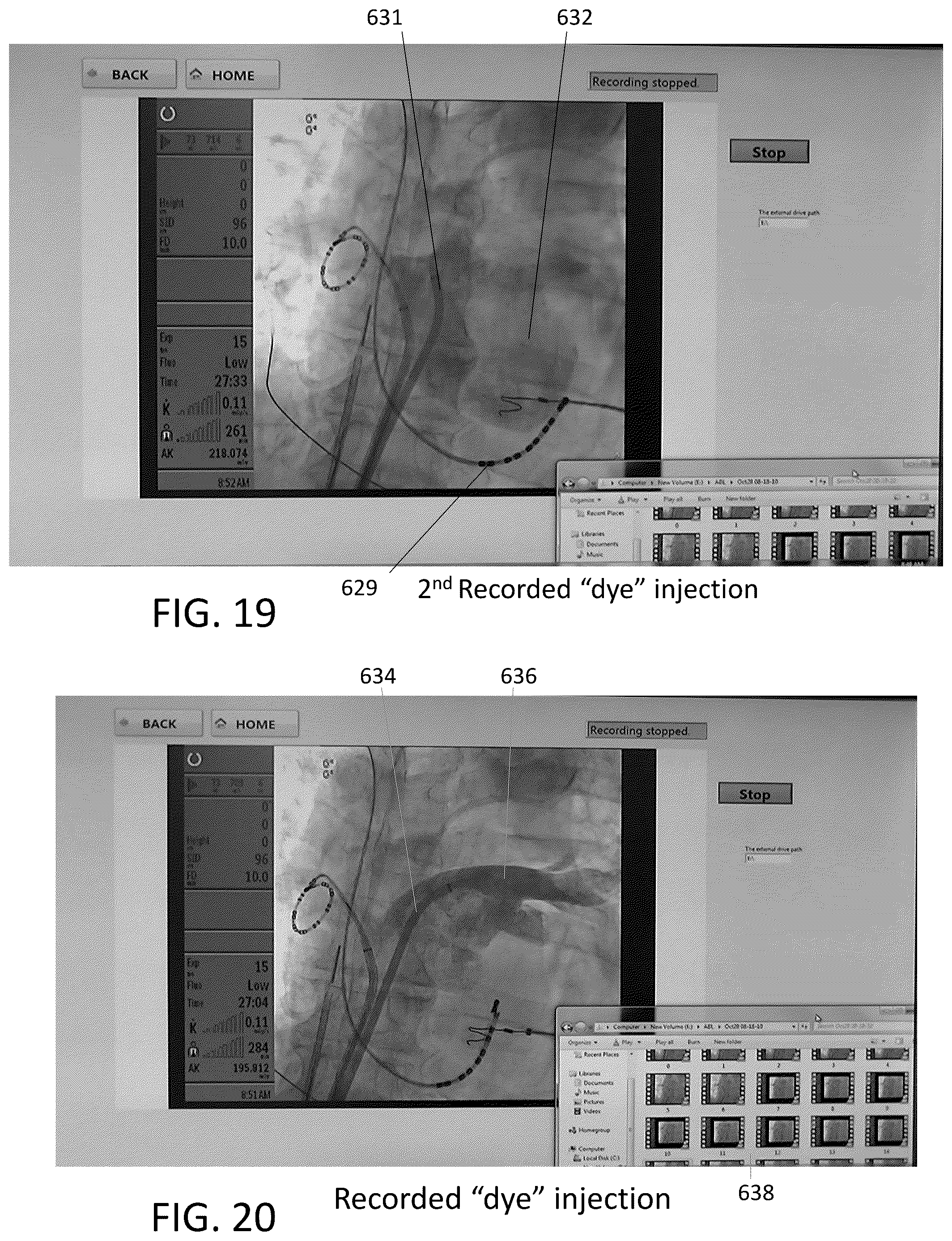 Patent US12303203 Figure 10 – Methods and system for atrial fibrillation ablation using balloon based catheters and utilizing medical images (CT or MRI in segments) based cardiac mapping and/or utilizing virtual reality (VR), and/or augmented reality (AR), and/or mixed reality (MR) for aiding in cardiac procedures