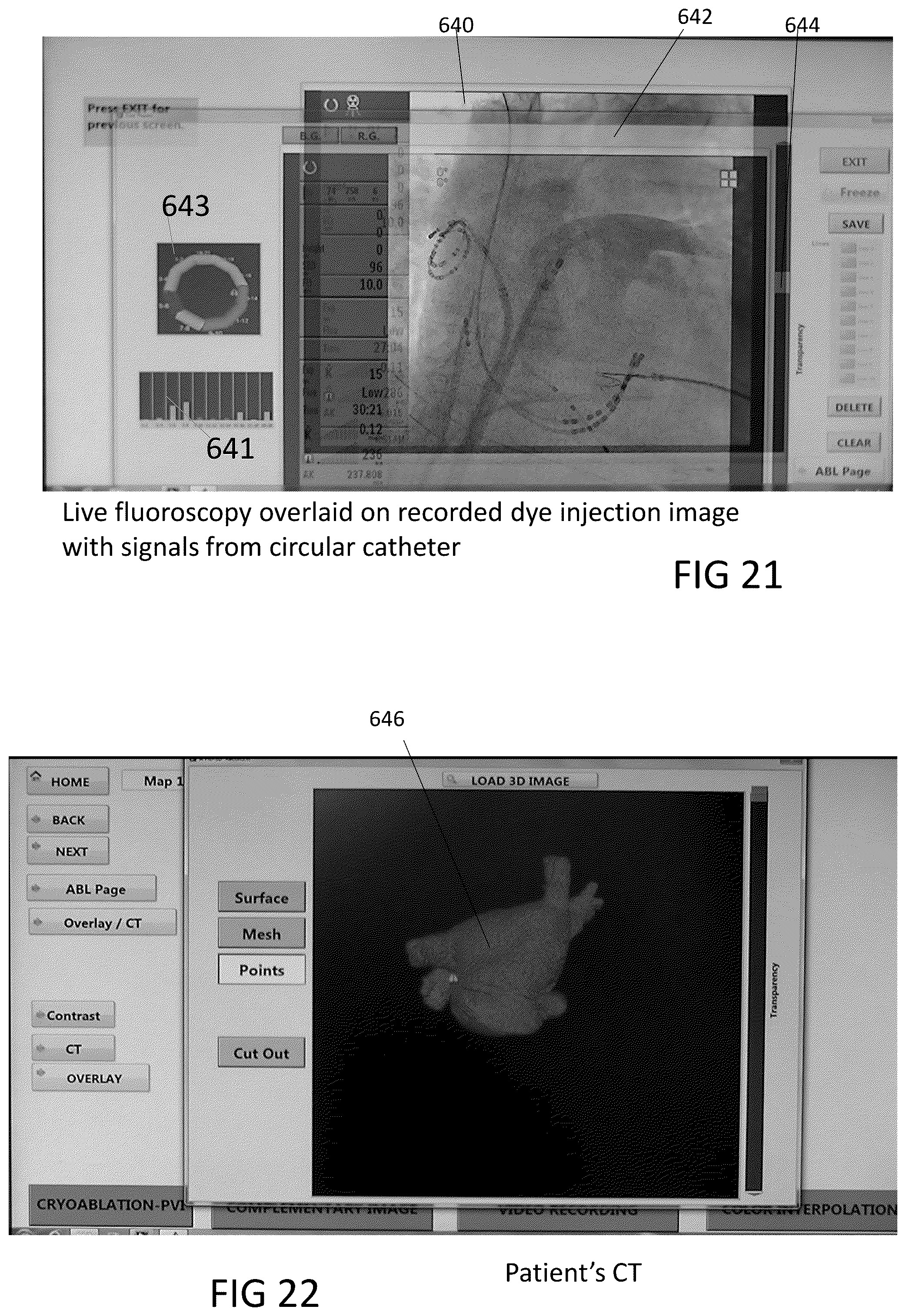 Patent US12303203 Figure 11 – Methods and system for atrial fibrillation ablation using balloon based catheters and utilizing medical images (CT or MRI in segments) based cardiac mapping and/or utilizing virtual reality (VR), and/or augmented reality (AR), and/or mixed reality (MR) for aiding in cardiac procedures