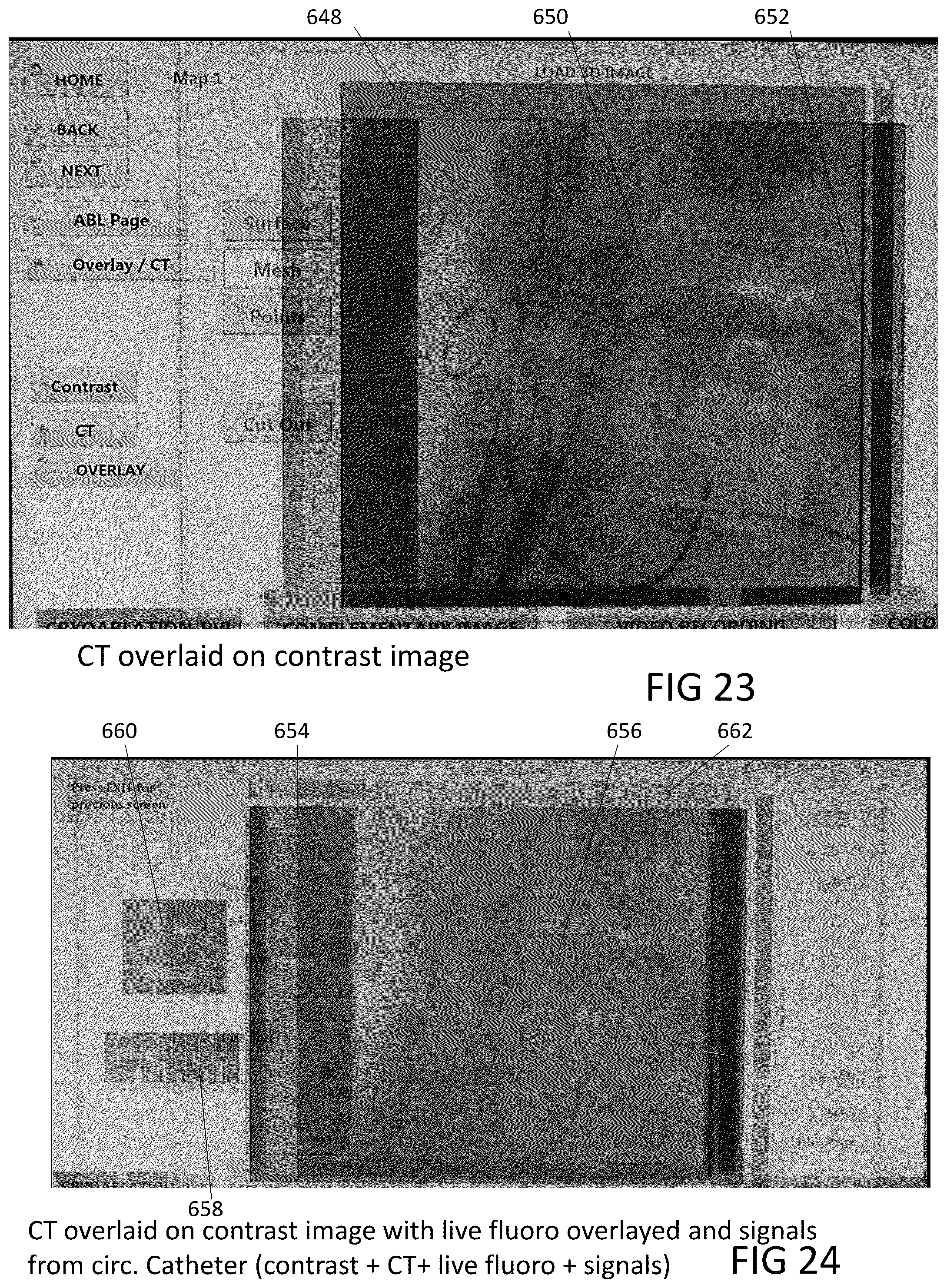 Patent US12303203 Figure 12 – Methods and system for atrial fibrillation ablation using balloon based catheters and utilizing medical images (CT or MRI in segments) based cardiac mapping and/or utilizing virtual reality (VR), and/or augmented reality (AR), and/or mixed reality (MR) for aiding in cardiac procedures