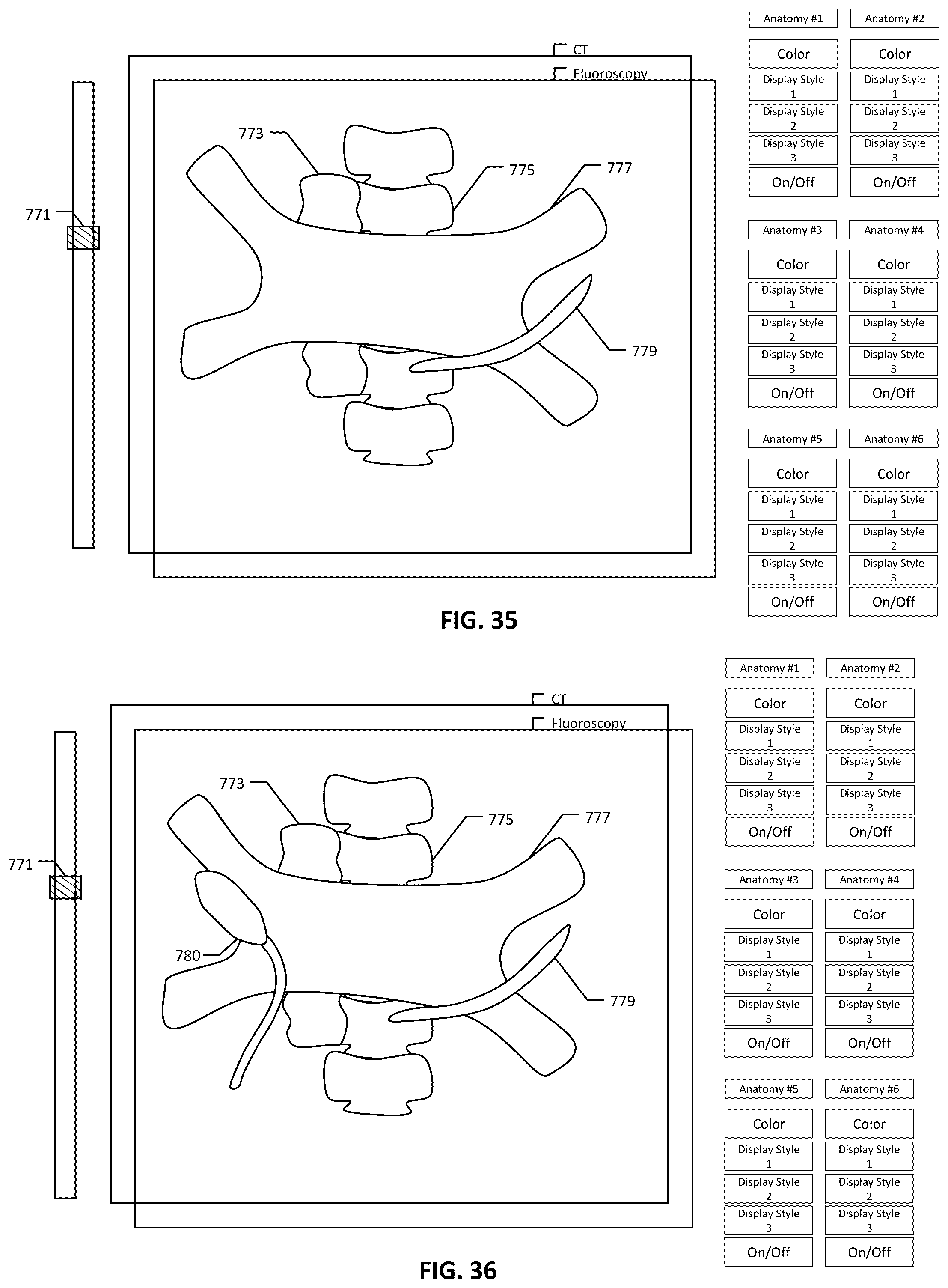 Patent US12303203 Figure 20 – Methods and system for atrial fibrillation ablation using balloon based catheters and utilizing medical images (CT or MRI in segments) based cardiac mapping and/or utilizing virtual reality (VR), and/or augmented reality (AR), and/or mixed reality (MR) for aiding in cardiac procedures