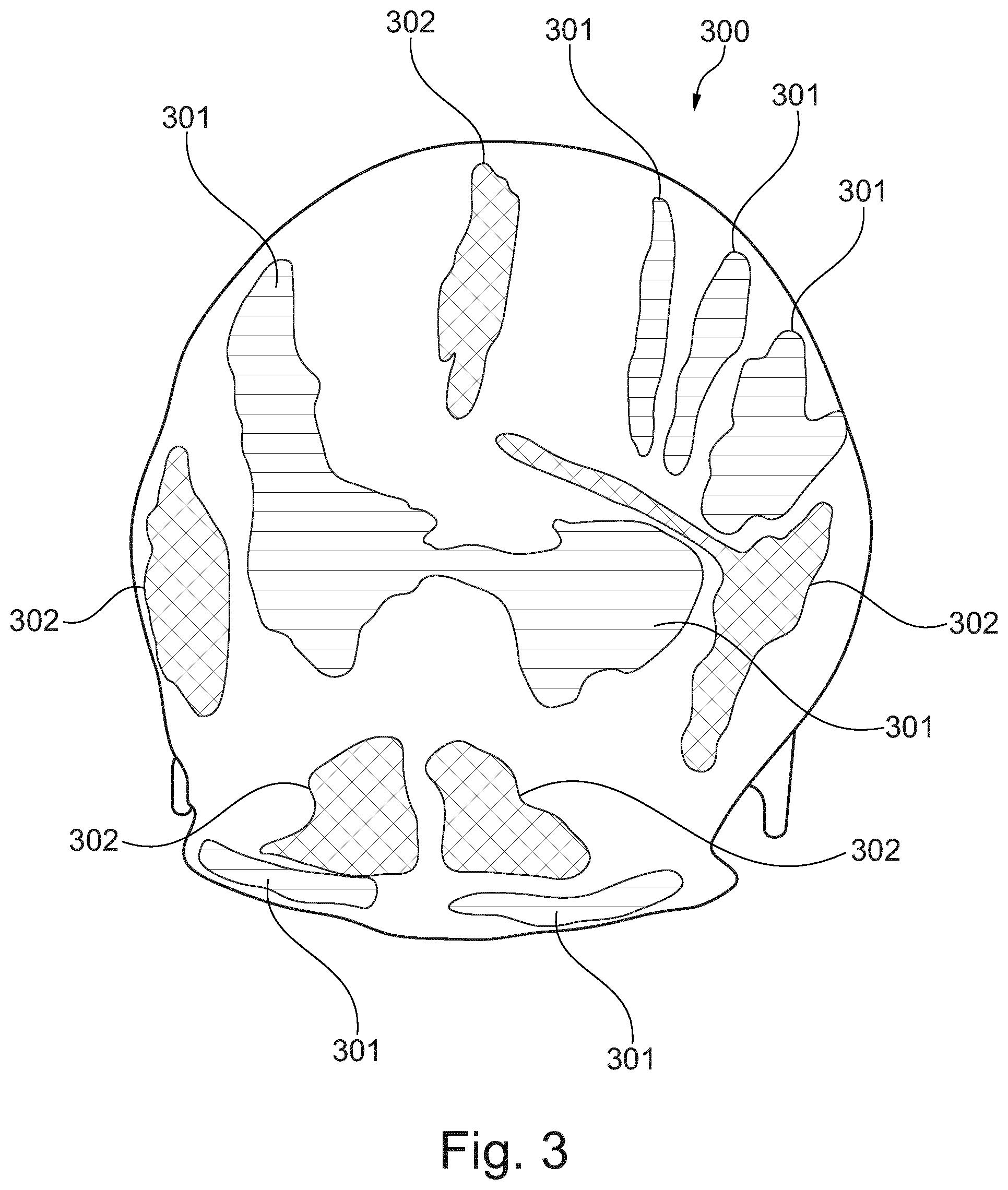 Patent US12303204 Figure 3 – Automated pre-operative assessment of implant placement in human bone