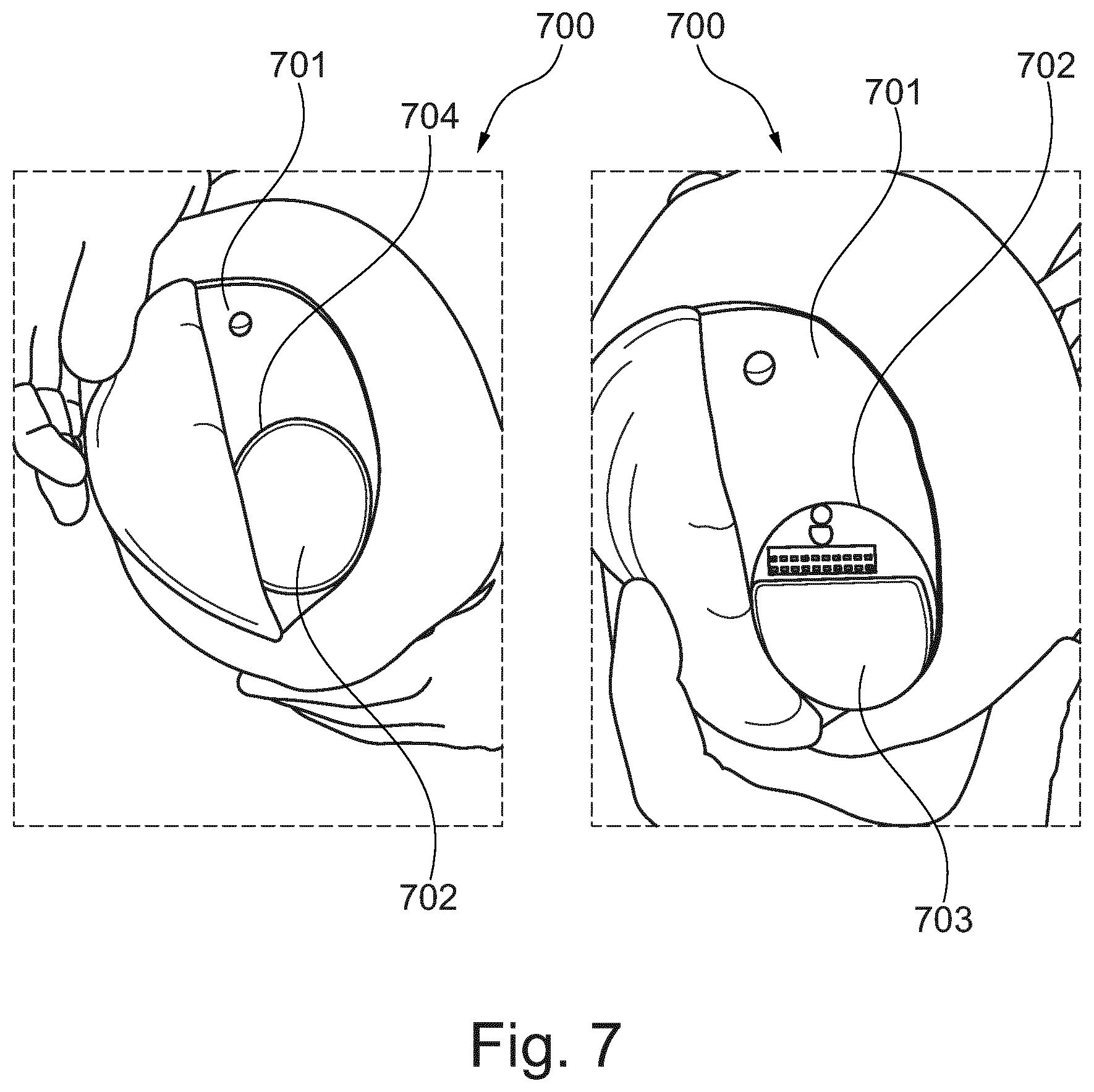 Patent US12303204 Figure 7 – Automated pre-operative assessment of implant placement in human bone