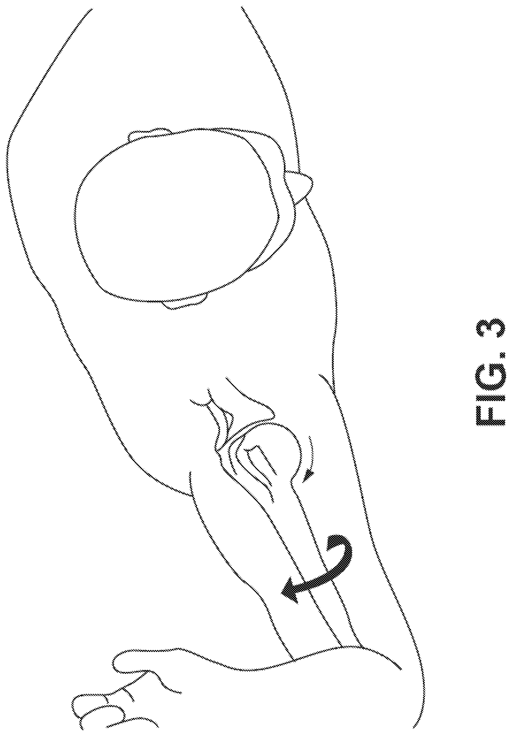 Patent US12303207 Figure 3 – Automated planning of shoulder stability enhancement surgeries
