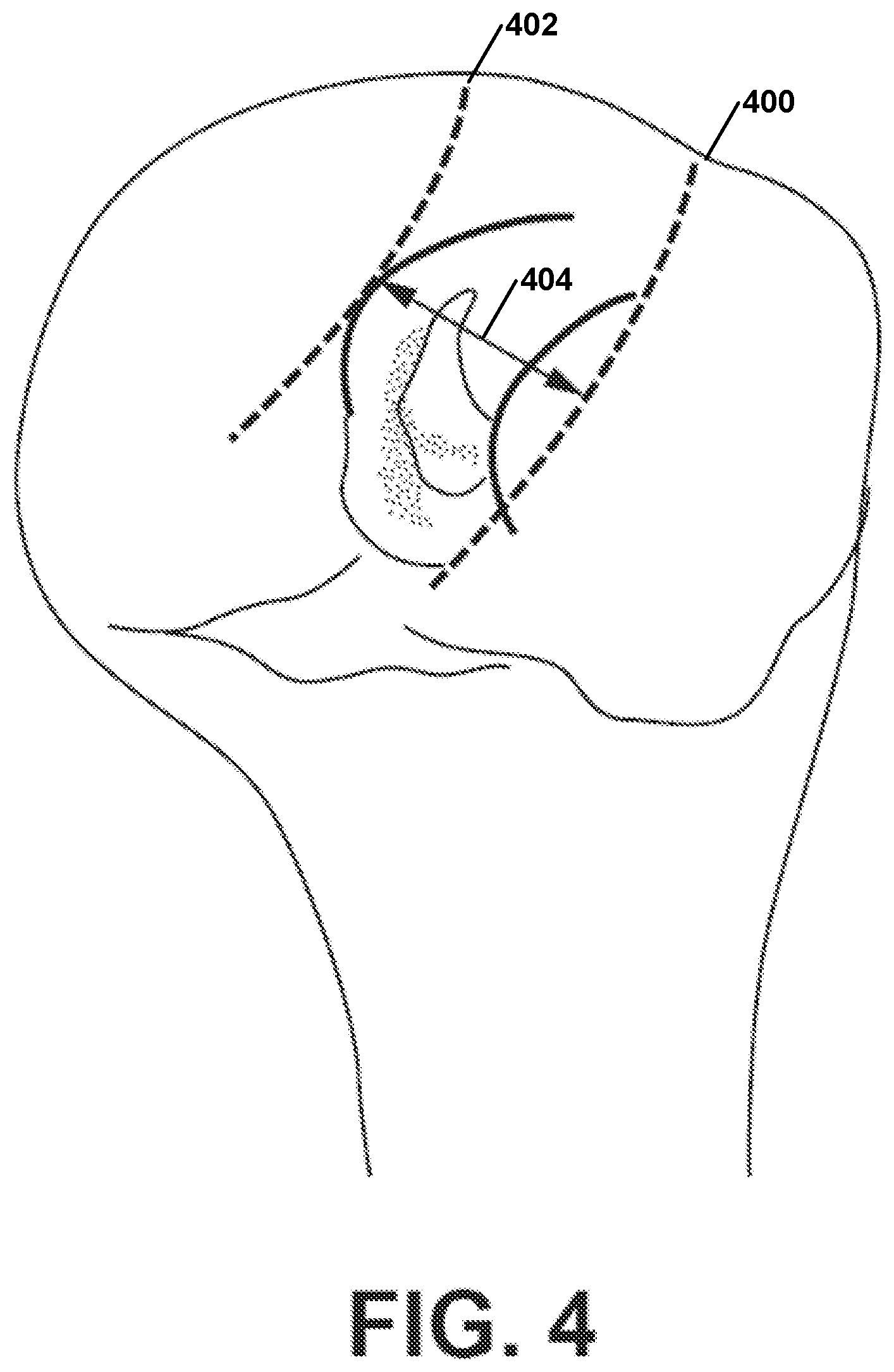 Patent US12303207 Figure 4 – Automated planning of shoulder stability enhancement surgeries