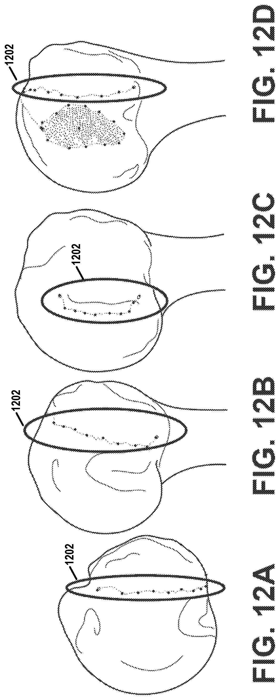 Patent US12303207 Figure 12 – Automated planning of shoulder stability enhancement surgeries