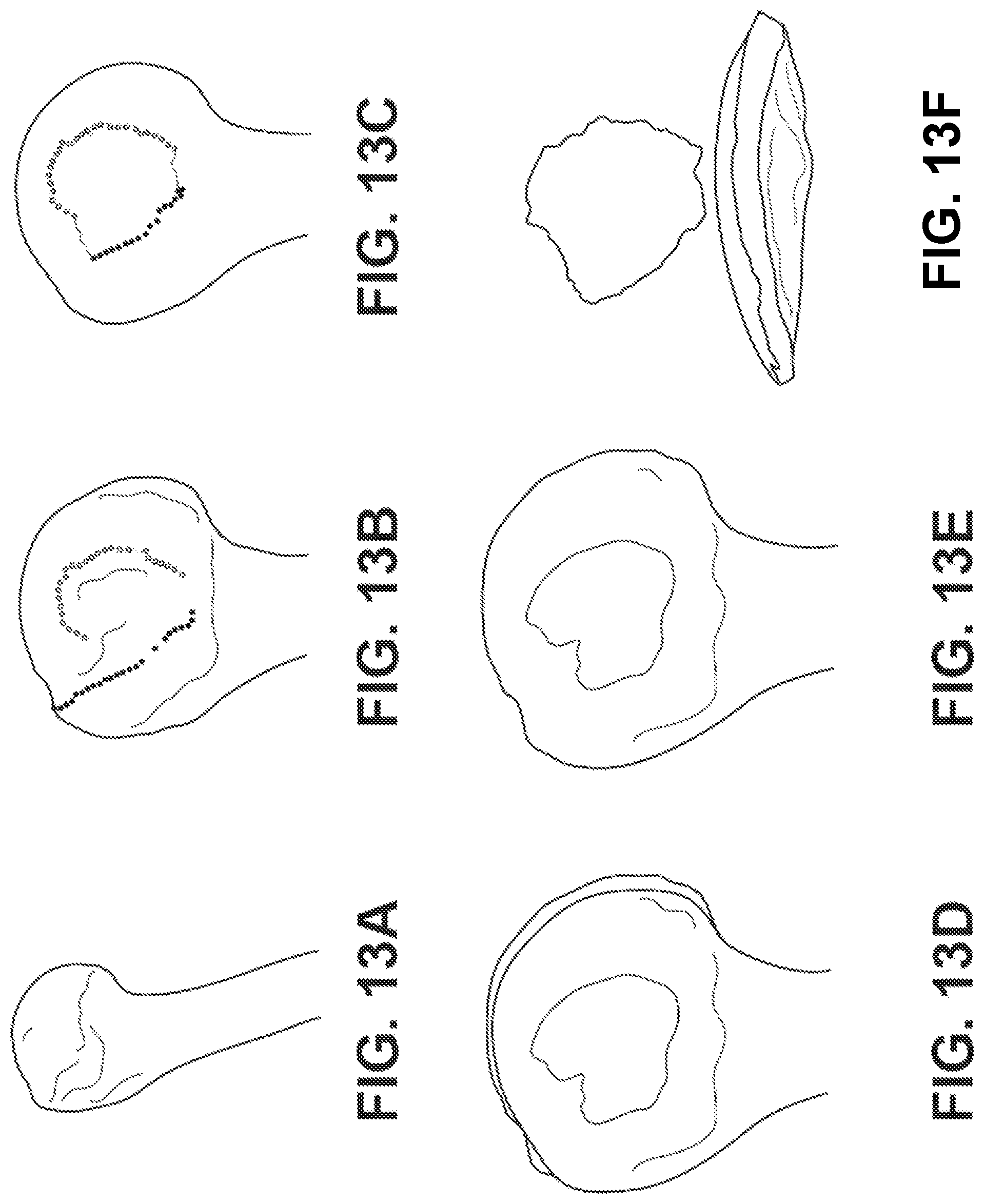 Patent US12303207 Figure 13 – Automated planning of shoulder stability enhancement surgeries